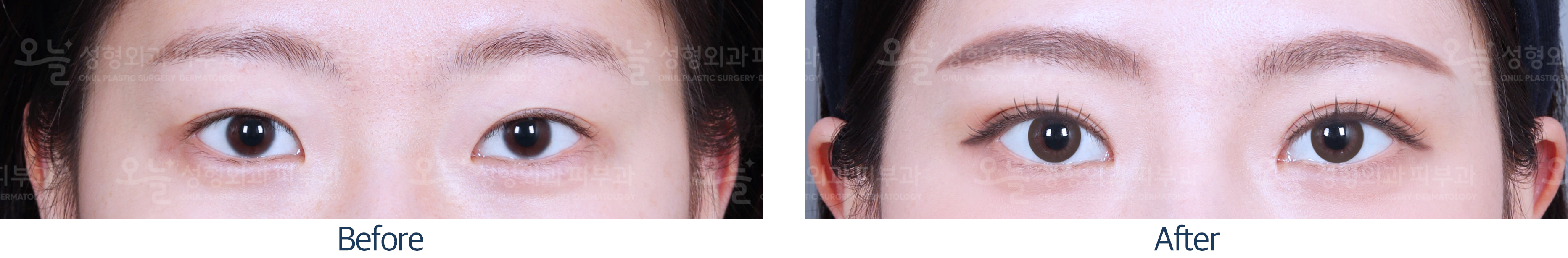 오늘성형외과 전후사진