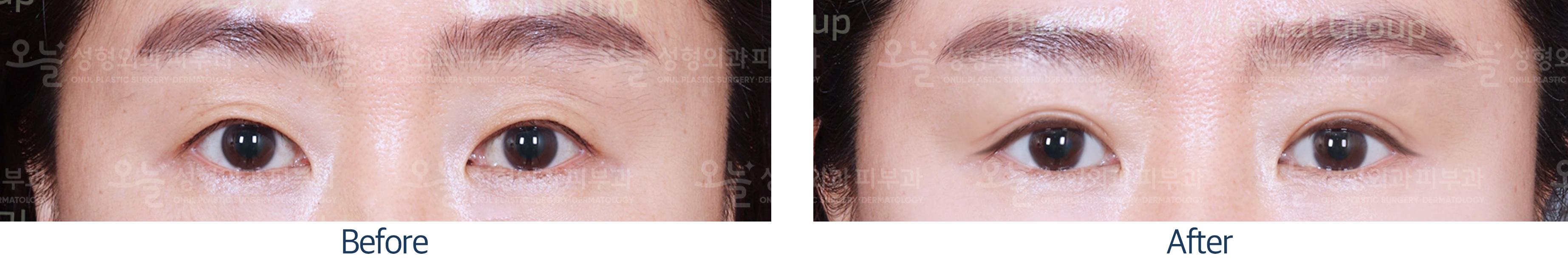오늘성형외과 전후사진