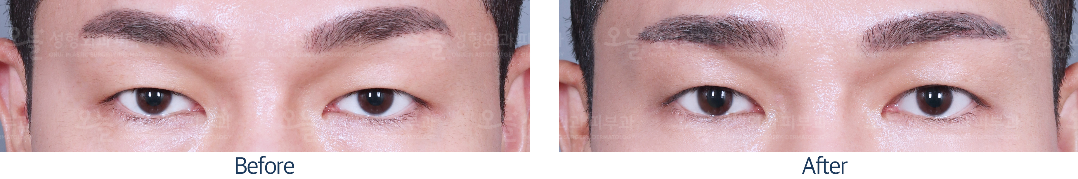 오늘성형외과 전후사진