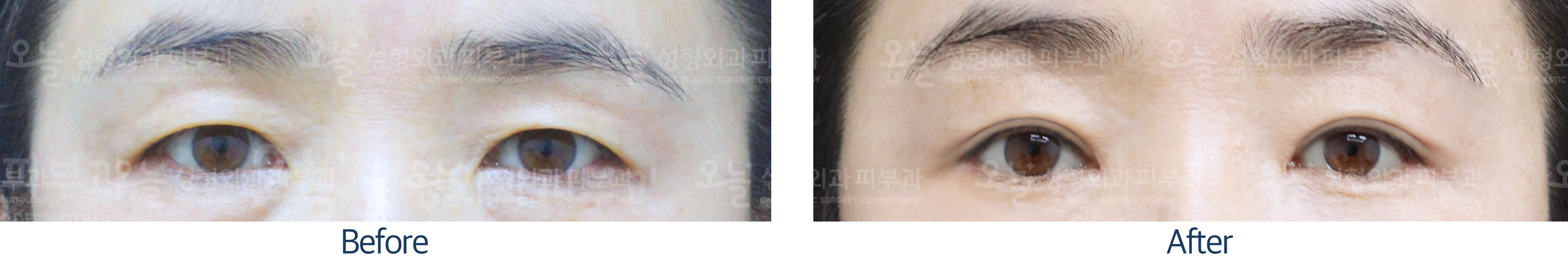 오늘성형외과 전후사진