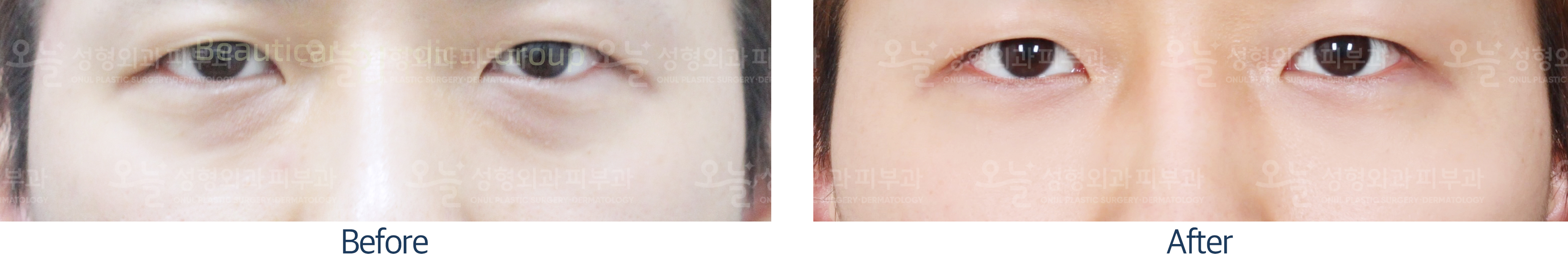 오늘성형외과 전후사진