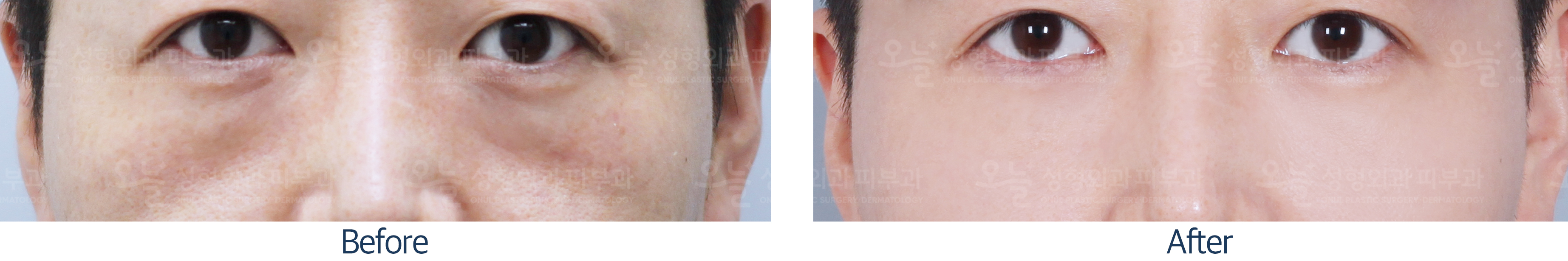 오늘성형외과 전후사진