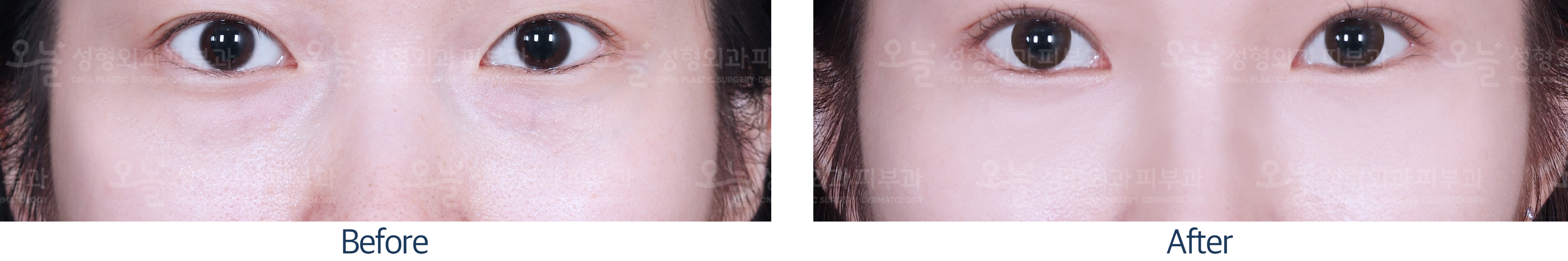 오늘성형외과 전후사진