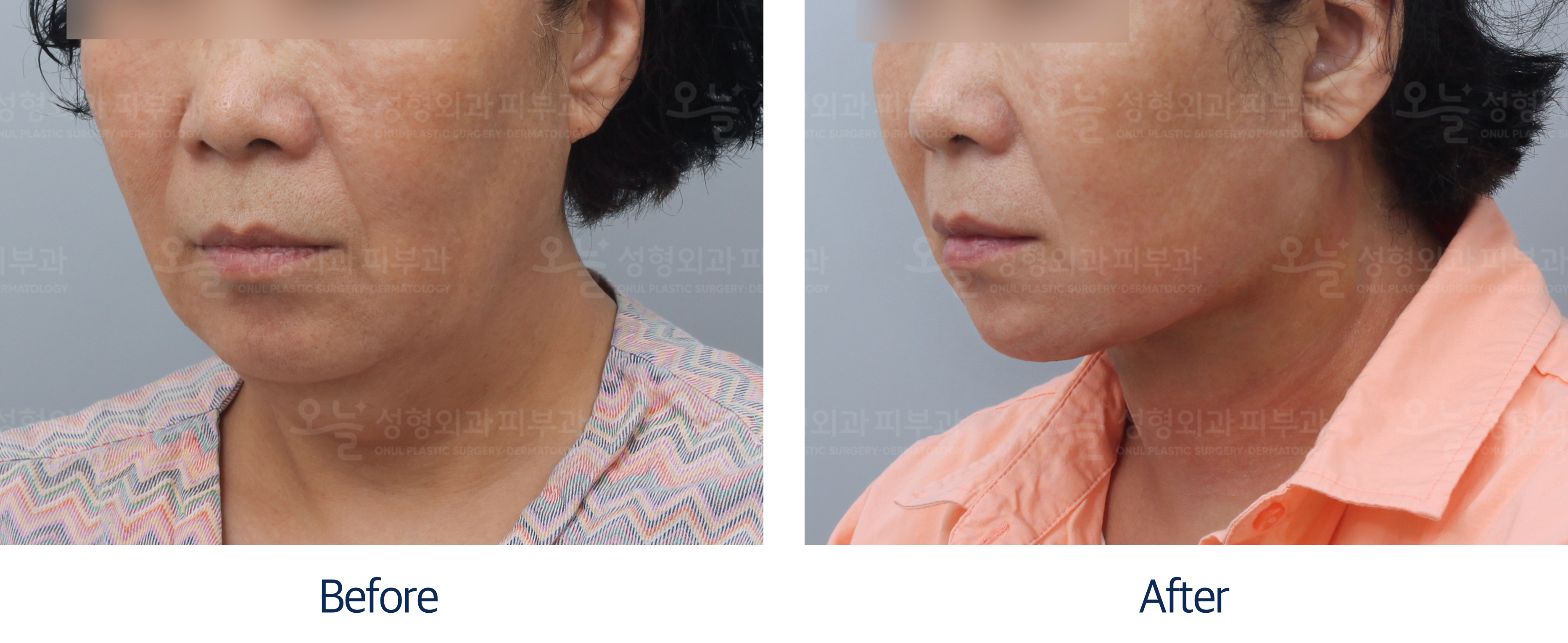 오늘성형외과 전후사진