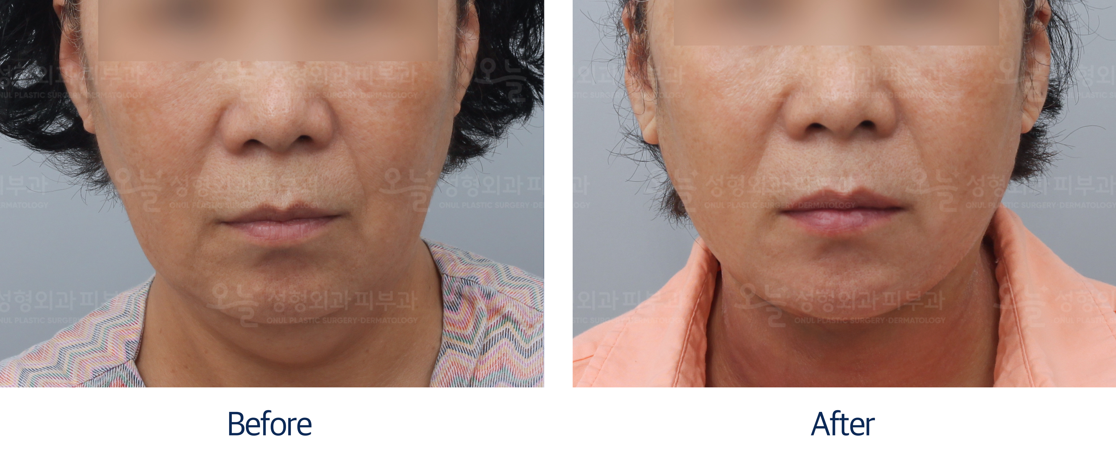 오늘성형외과 전후사진