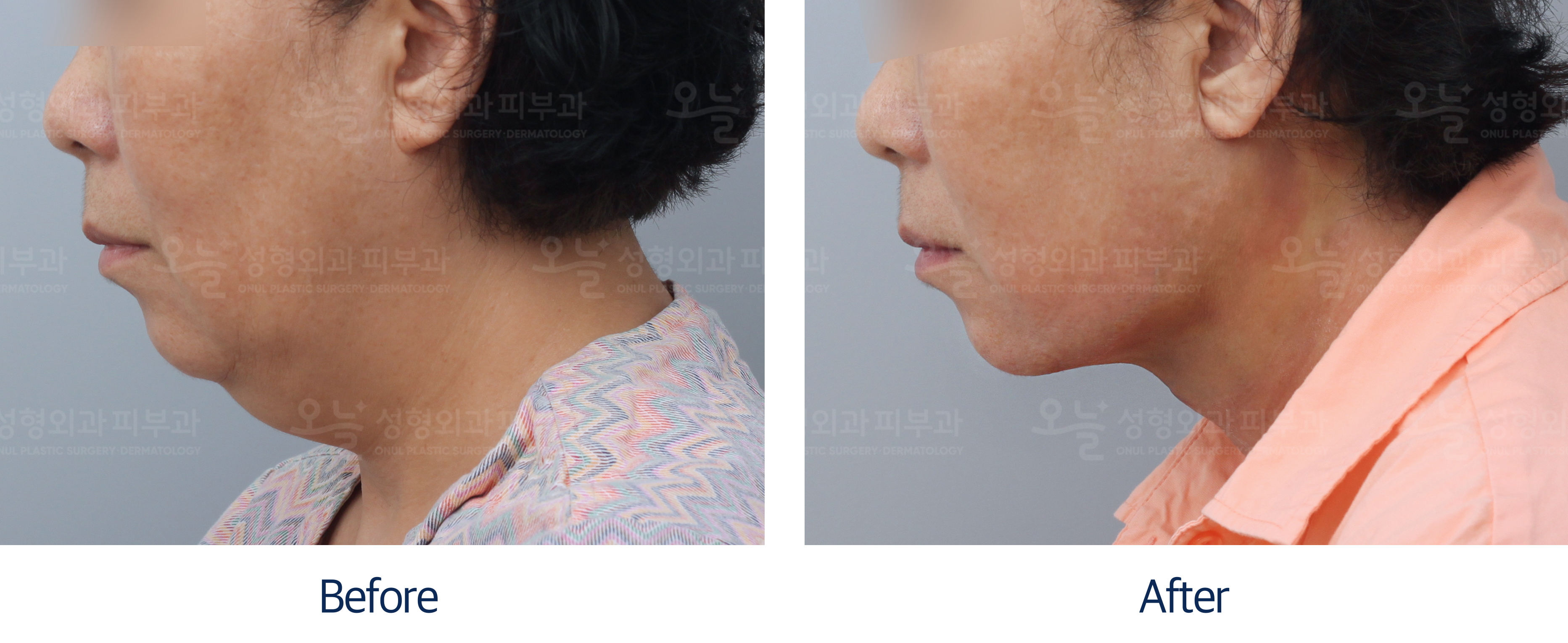 오늘성형외과 전후사진