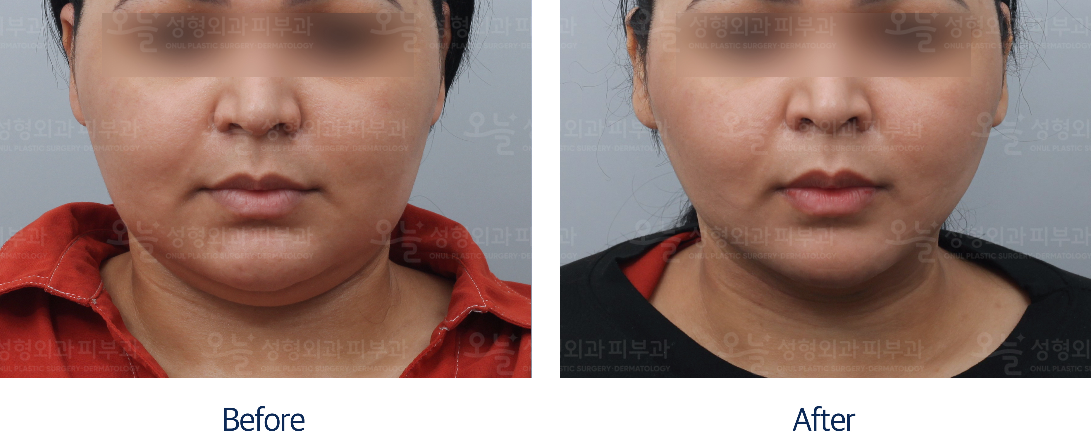 오늘성형외과 전후사진