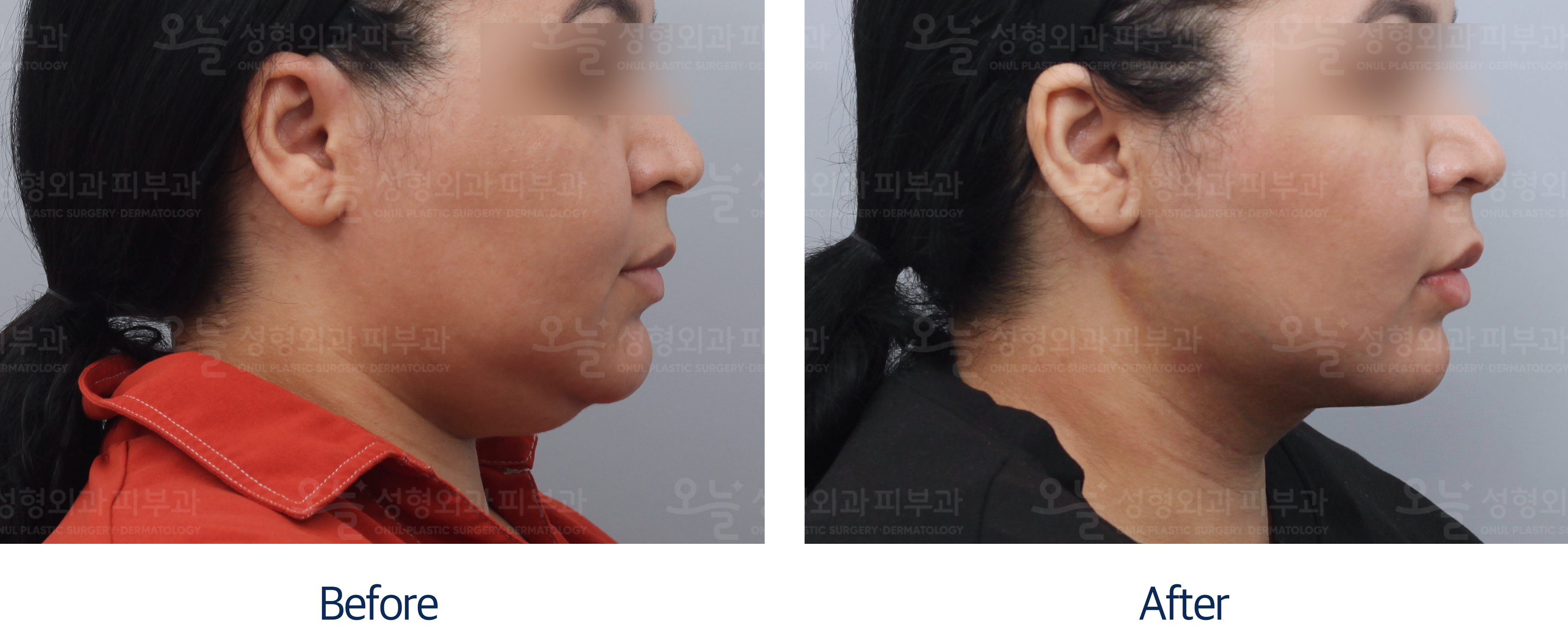 오늘성형외과 전후사진