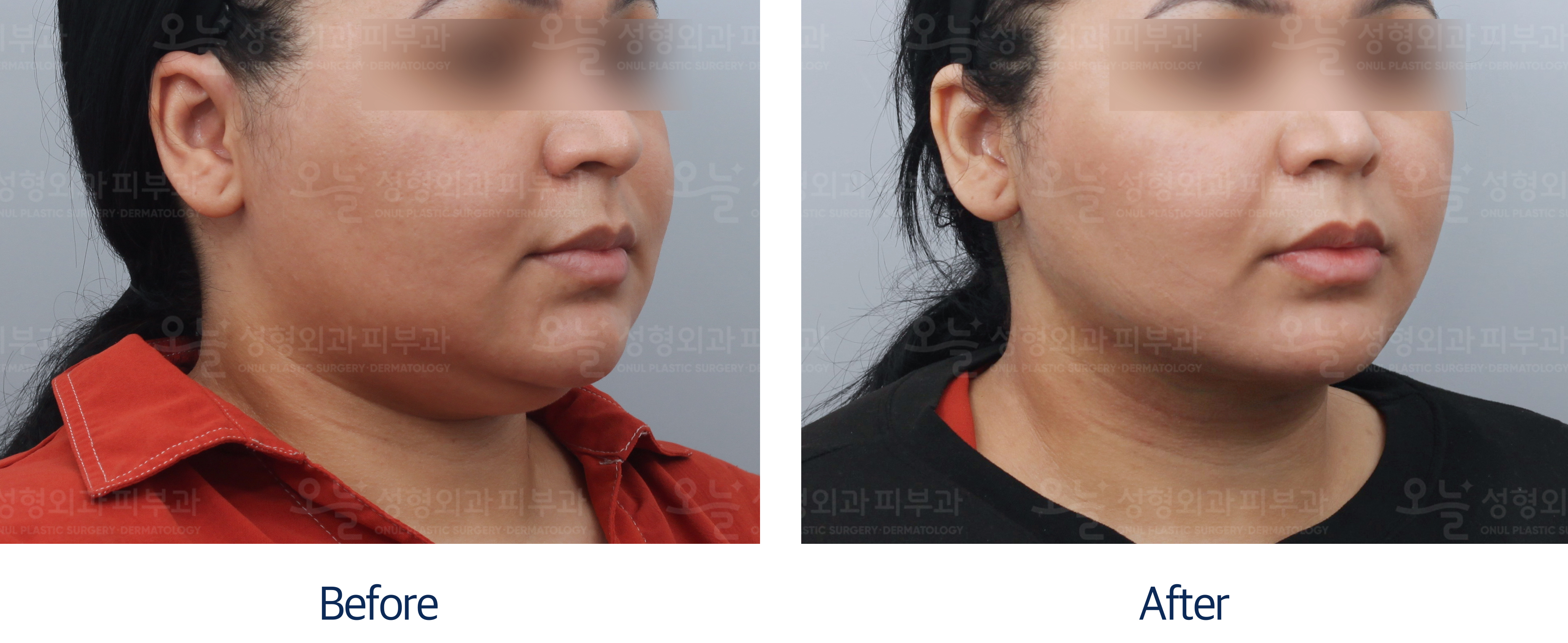 오늘성형외과 전후사진