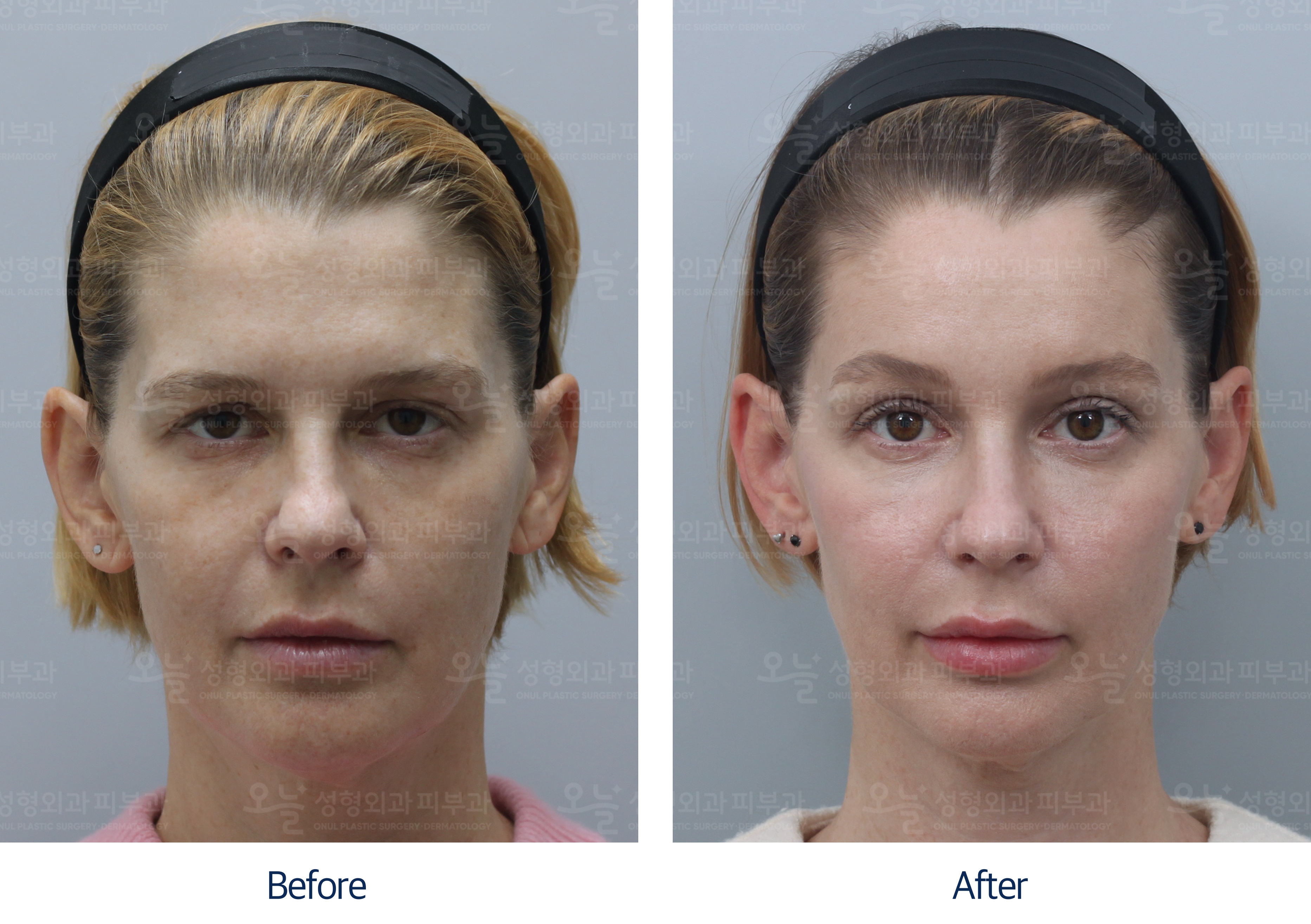 오늘성형외과 전후사진