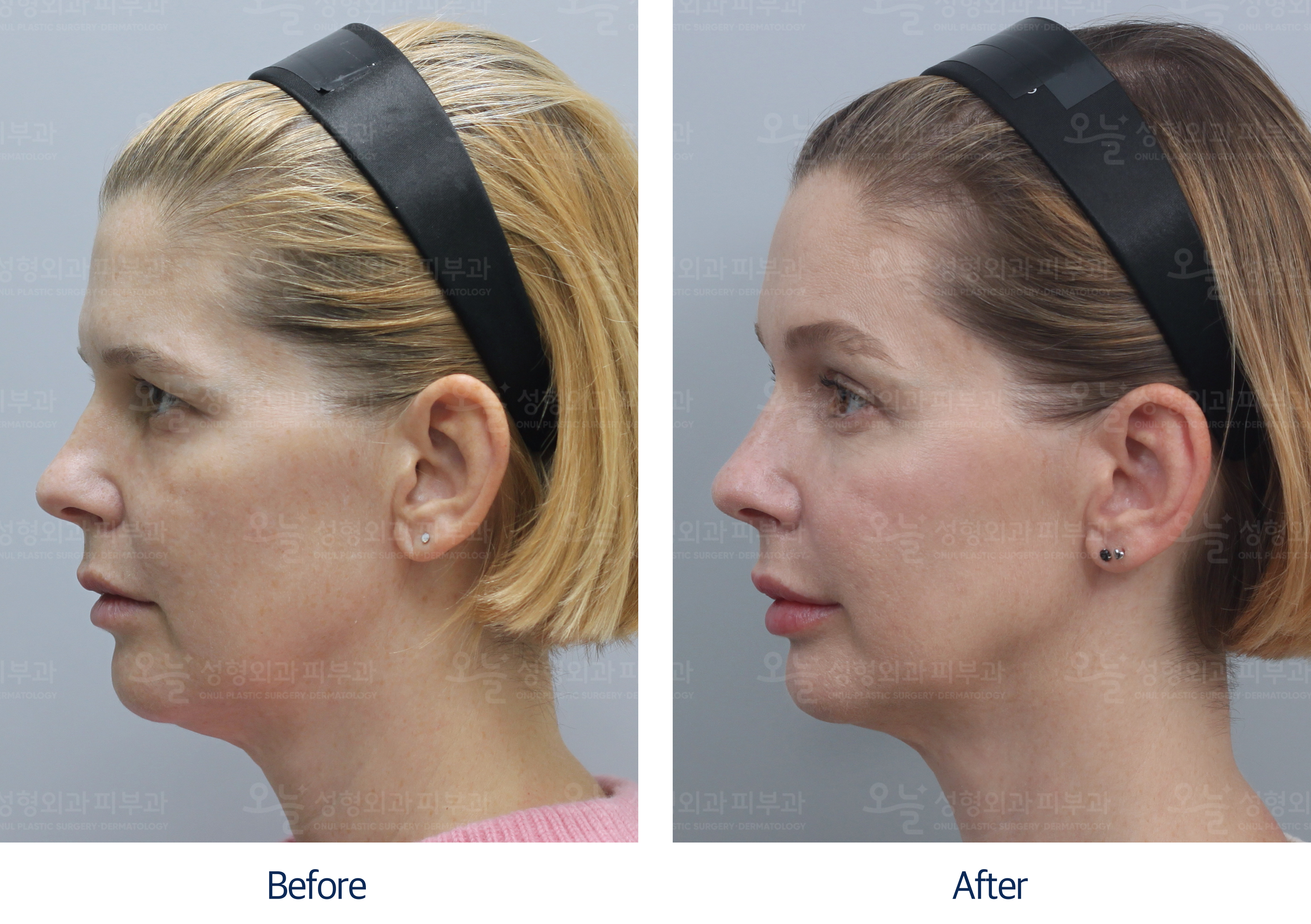 오늘성형외과 전후사진