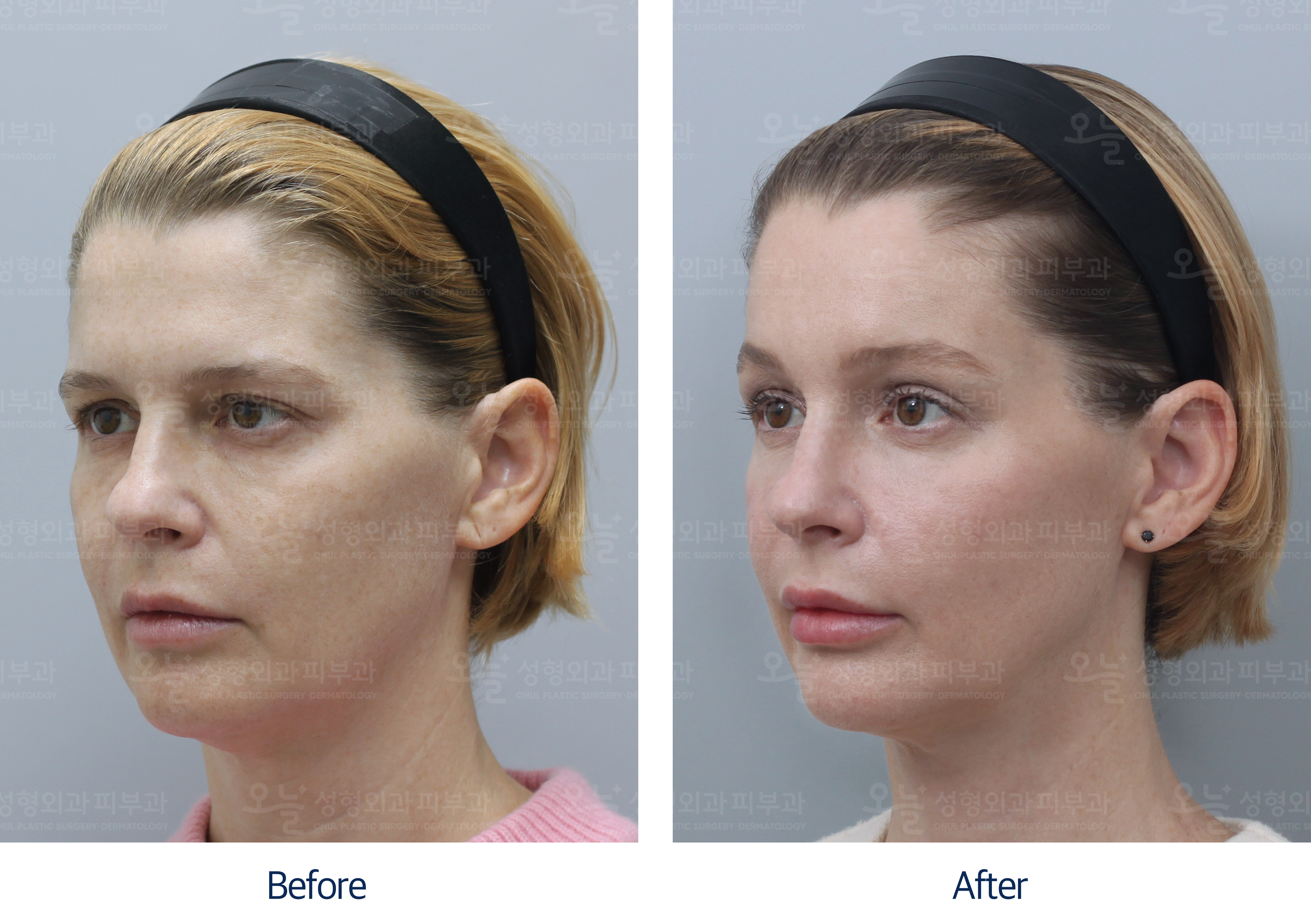 오늘성형외과 전후사진
