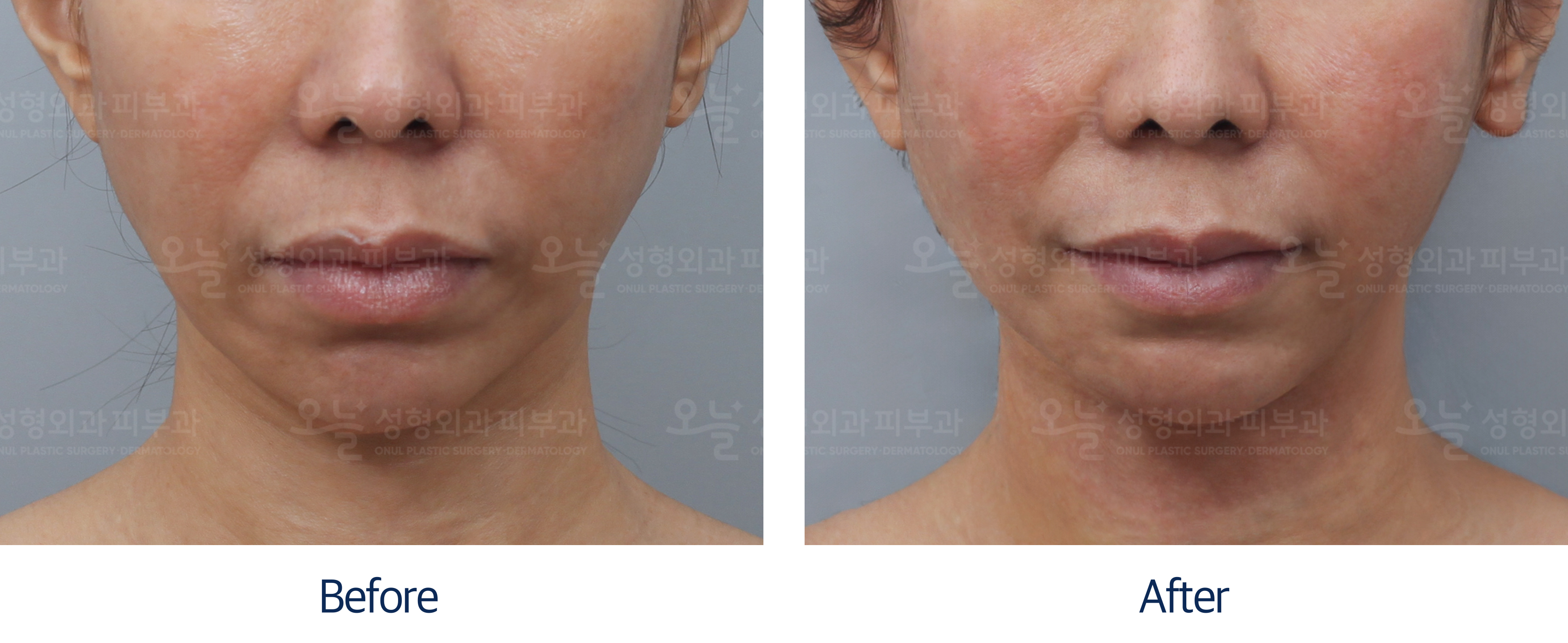 오늘성형외과 전후사진