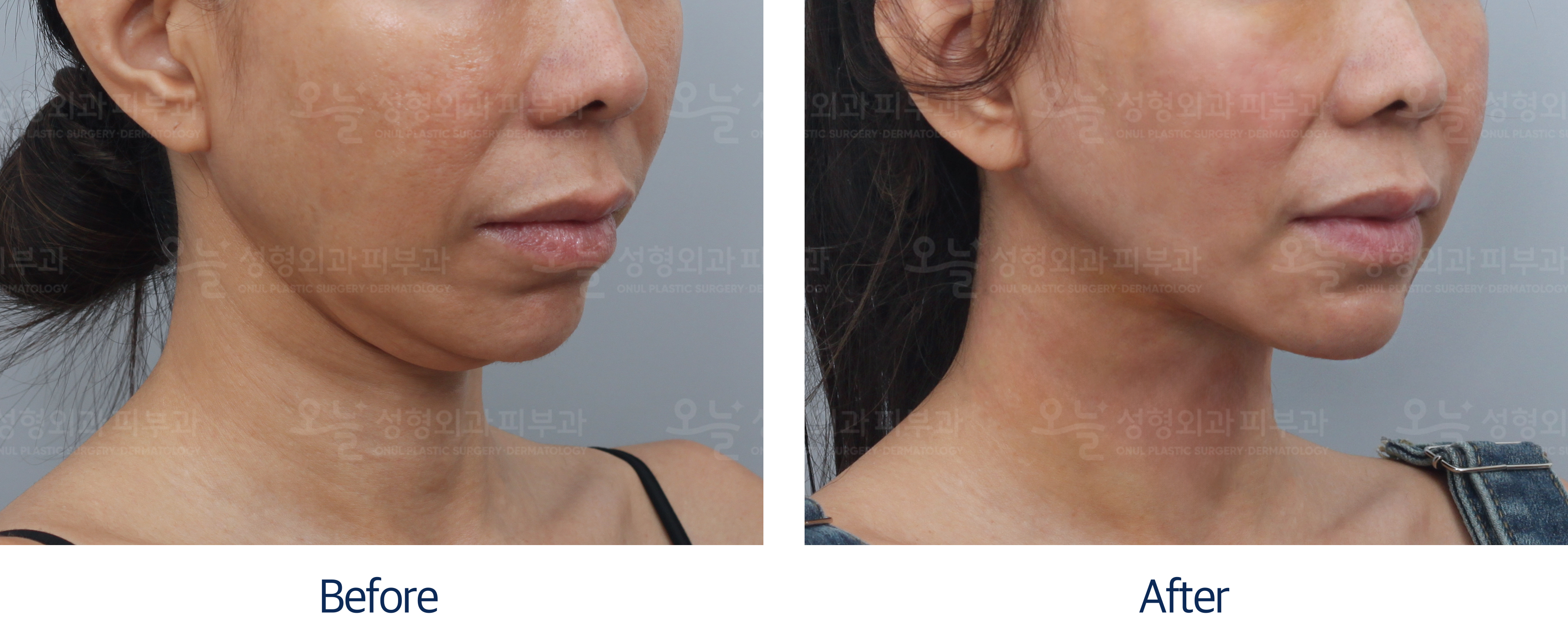 오늘성형외과 전후사진
