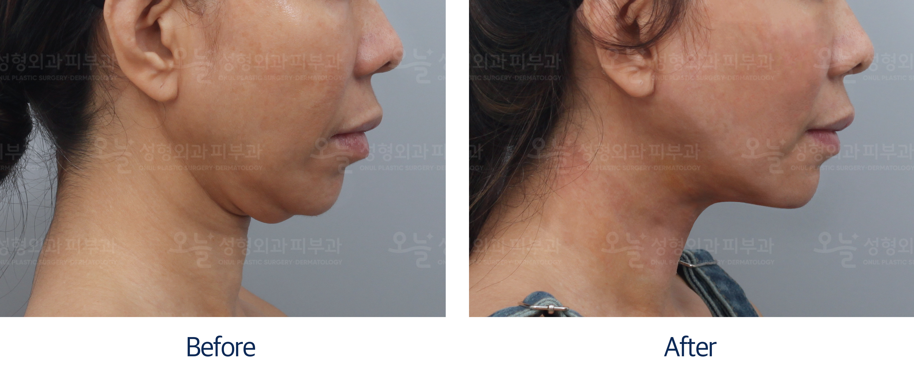 오늘성형외과 전후사진