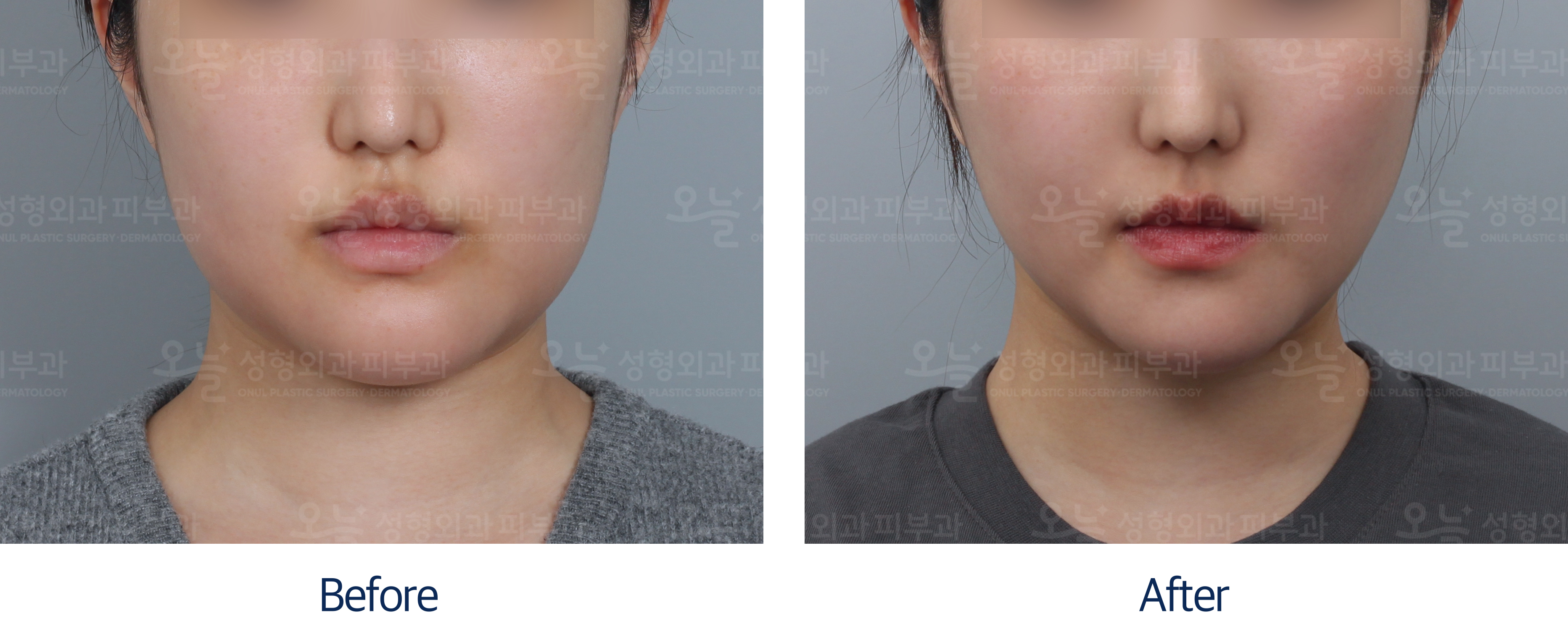 오늘성형외과 전후사진