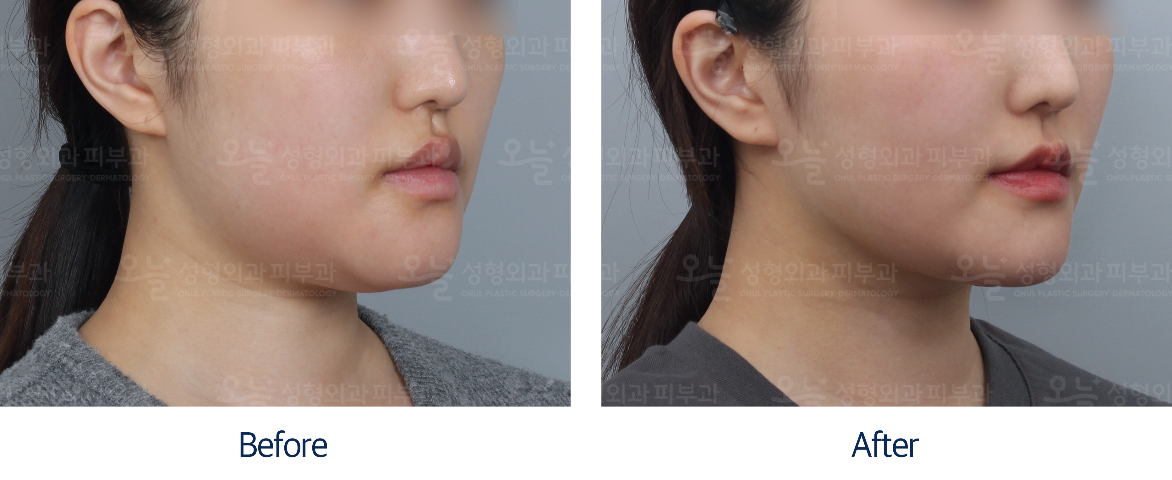 오늘성형외과 전후사진