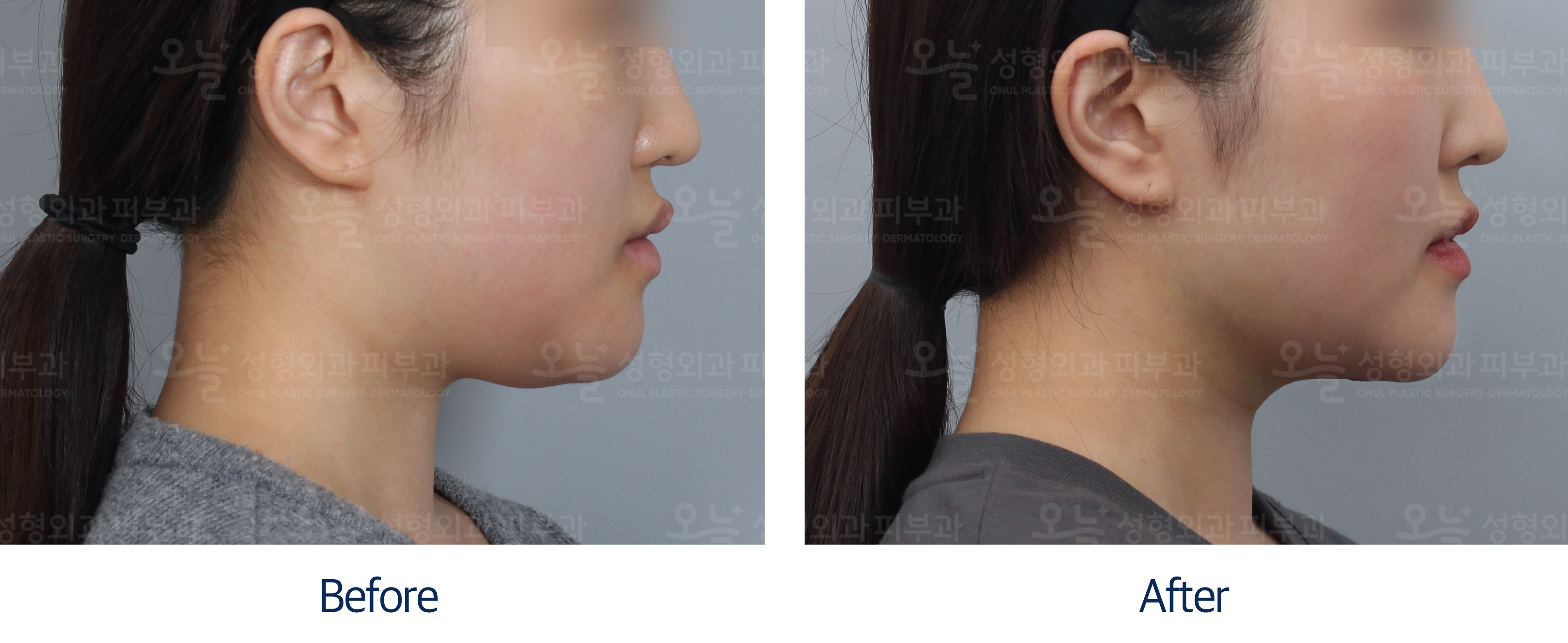 오늘성형외과 전후사진