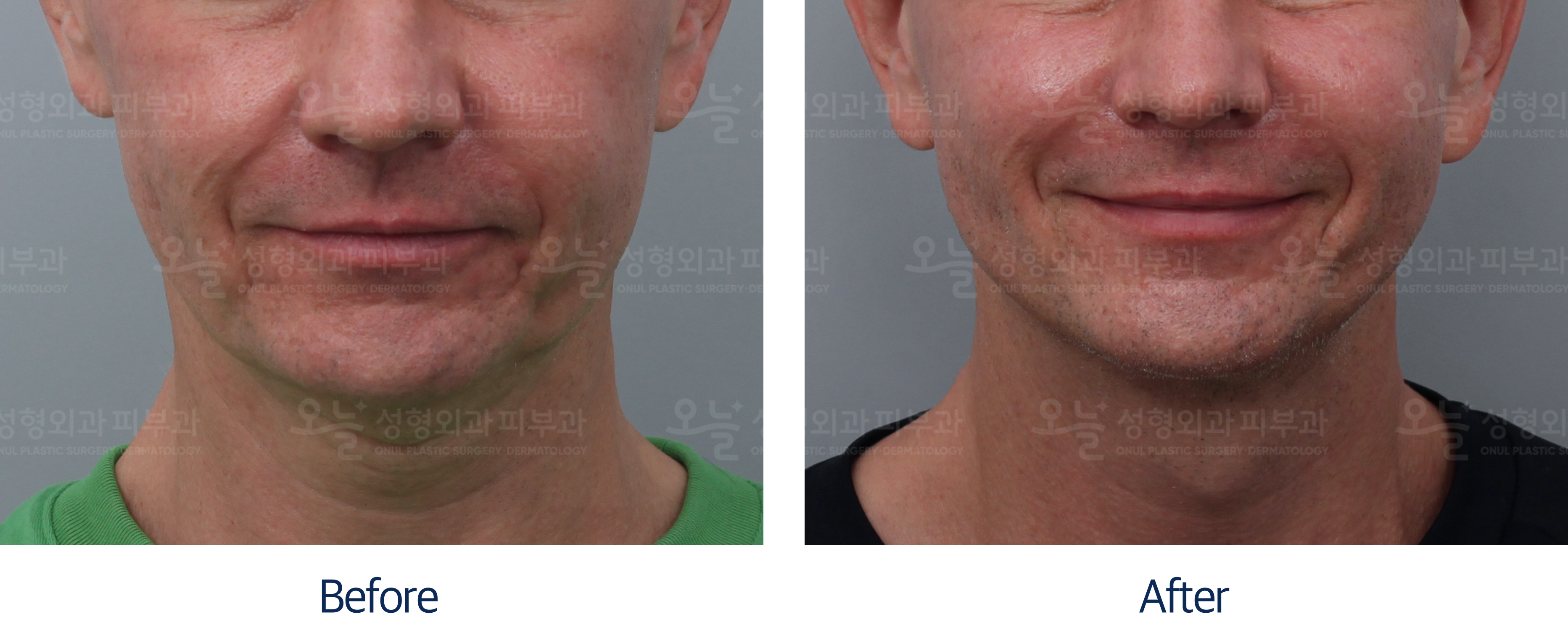 오늘성형외과 전후사진