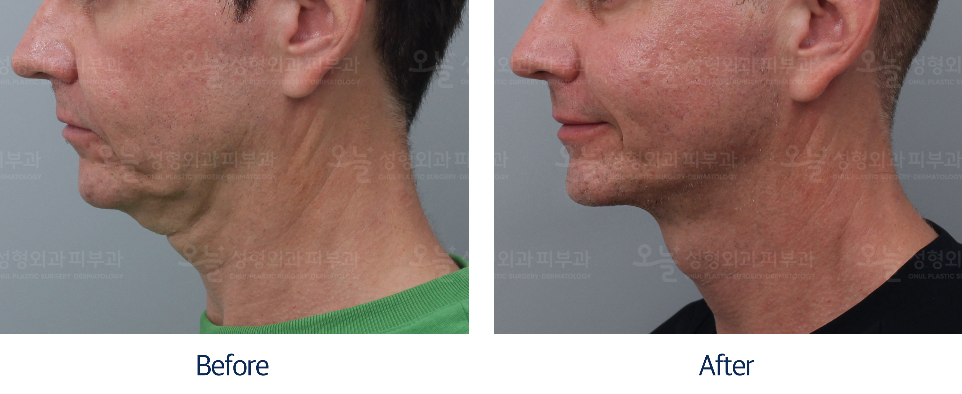 오늘성형외과 전후사진