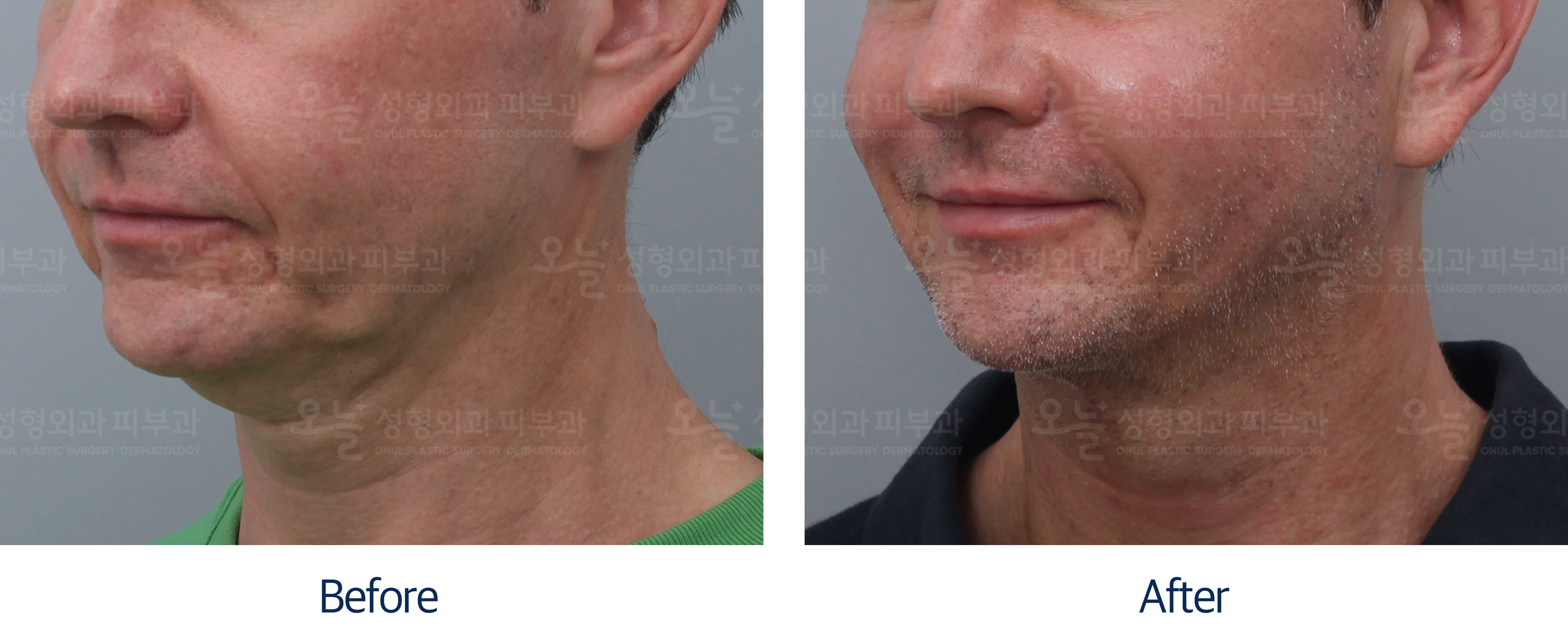 오늘성형외과 전후사진