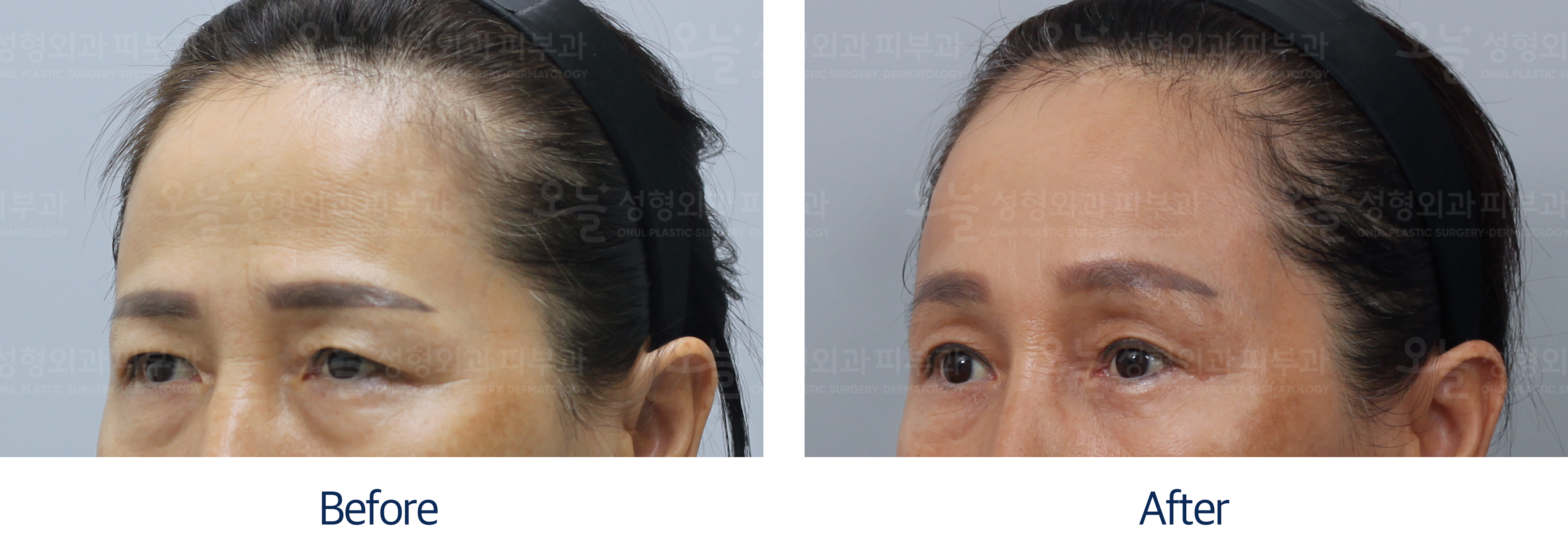 오늘성형외과 전후사진