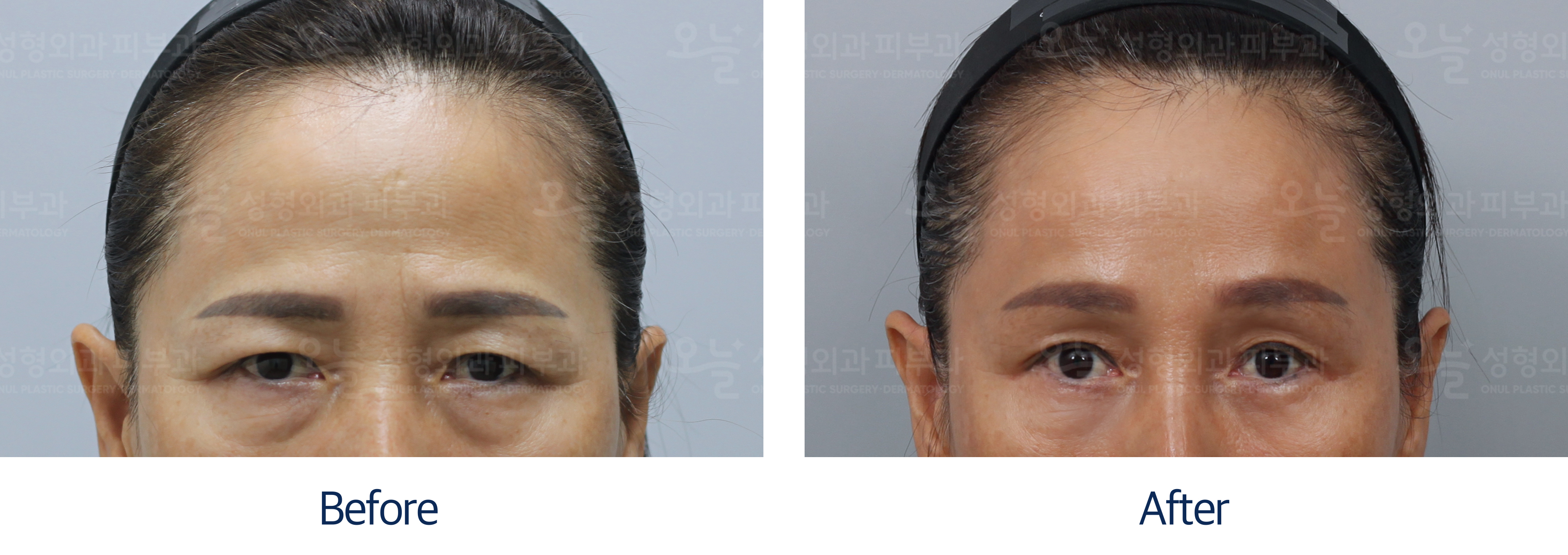 오늘성형외과 전후사진