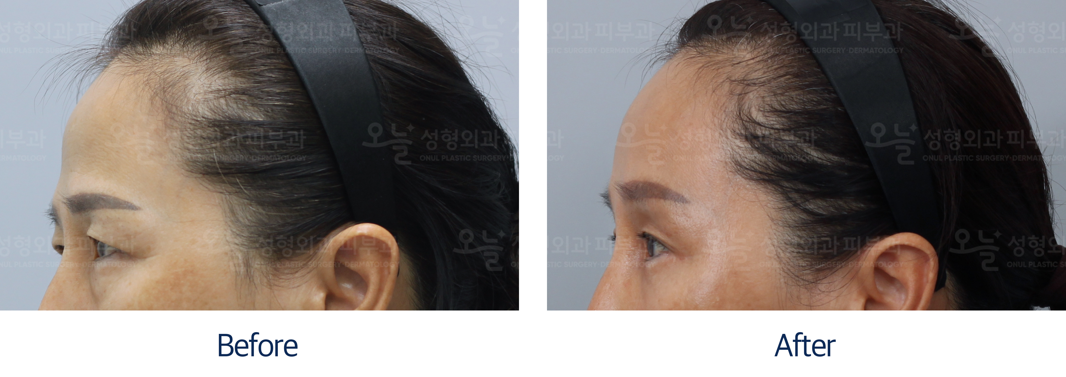 오늘성형외과 전후사진