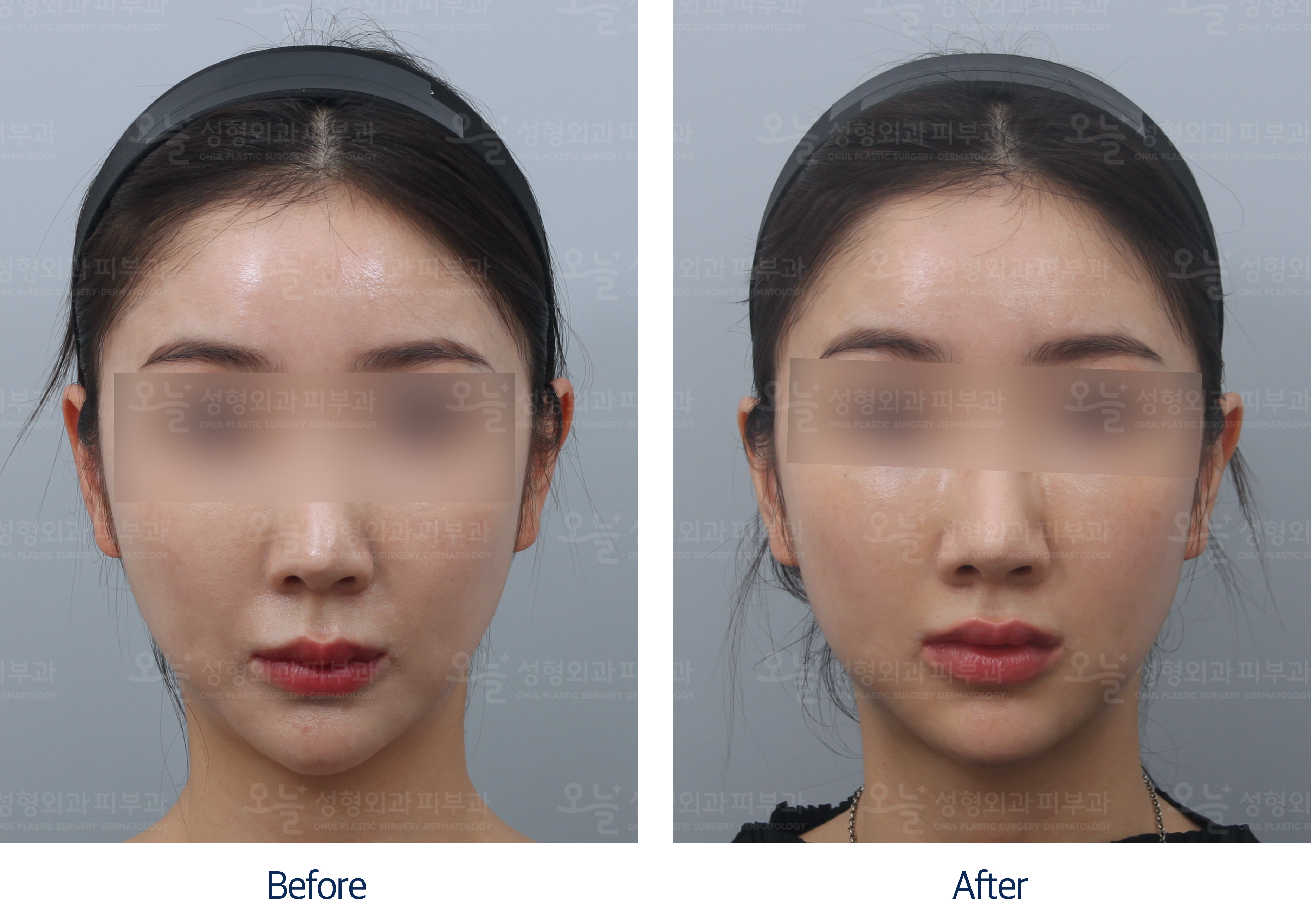 오늘성형외과 전후사진