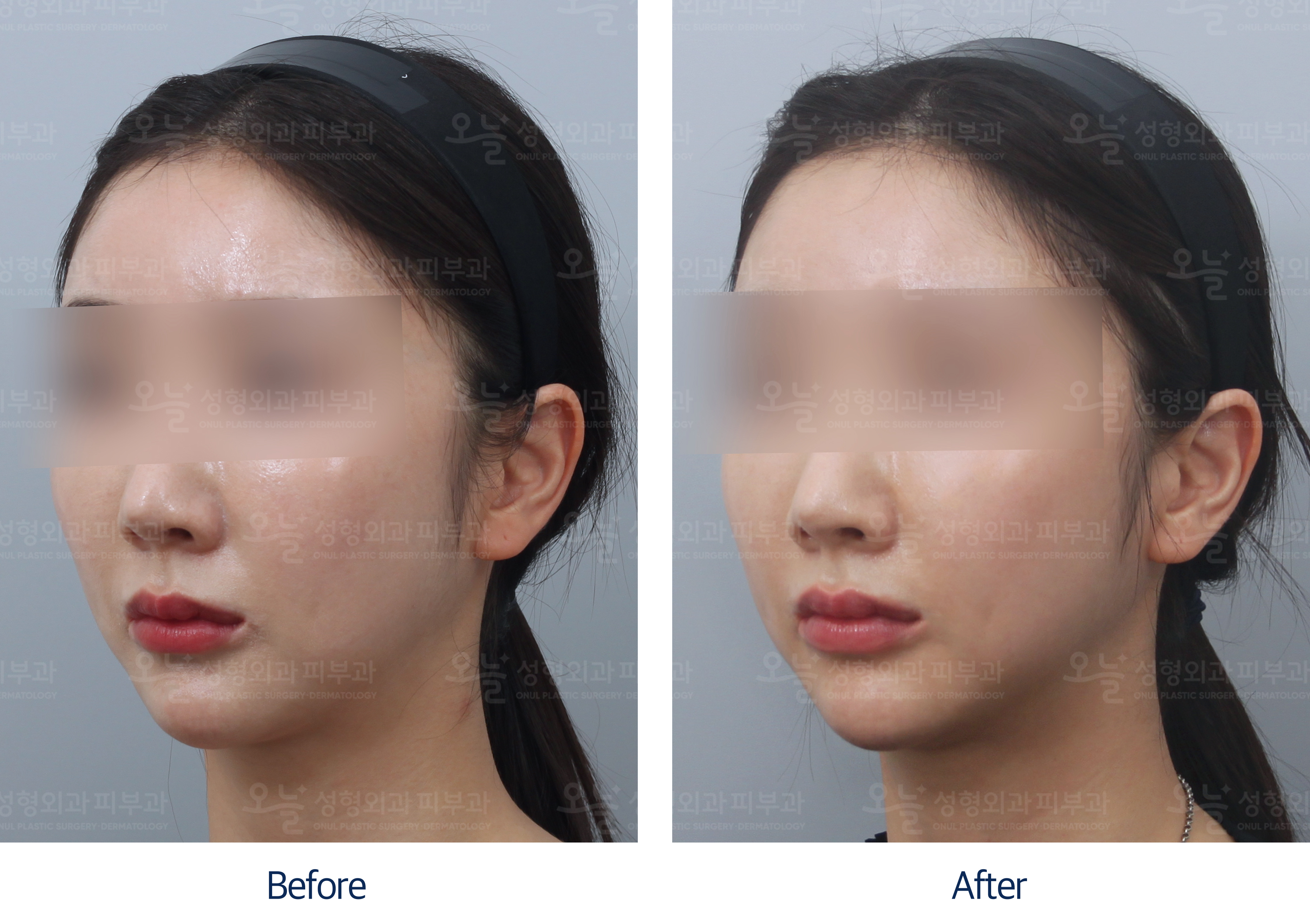 오늘성형외과 전후사진