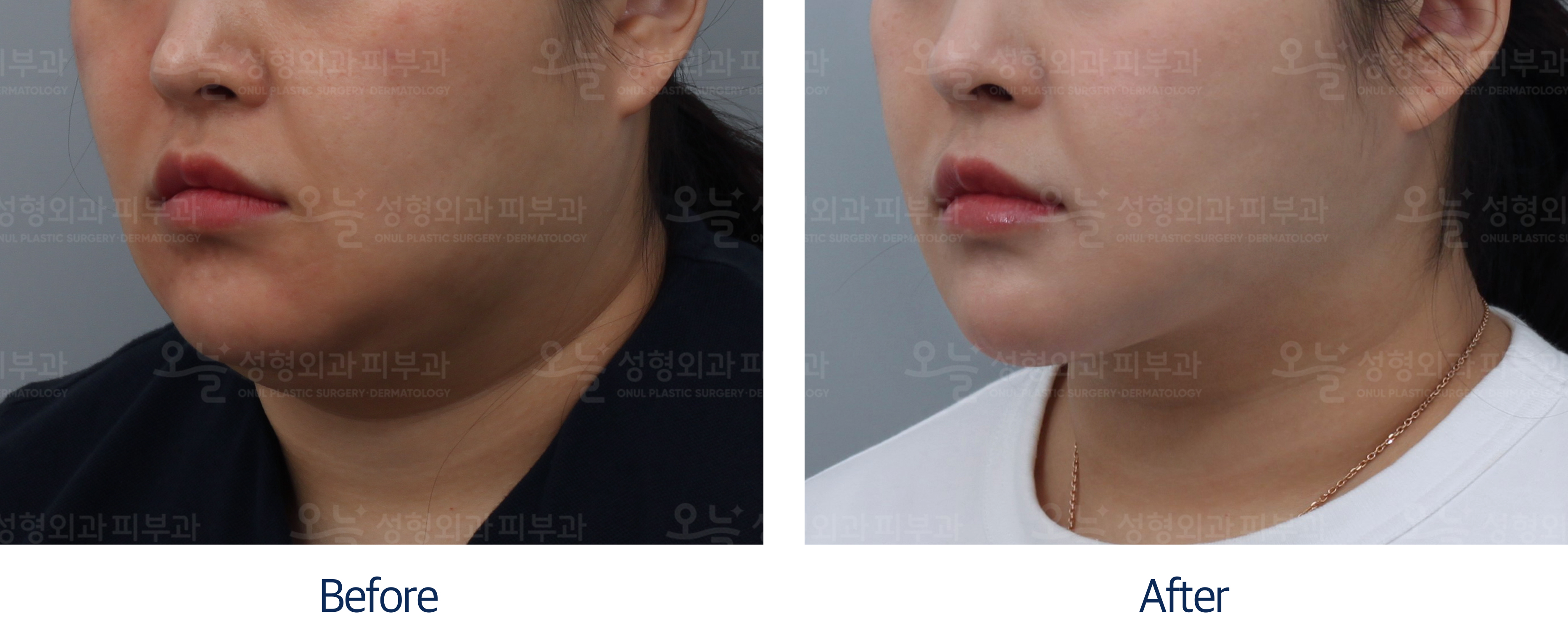 오늘성형외과 전후사진