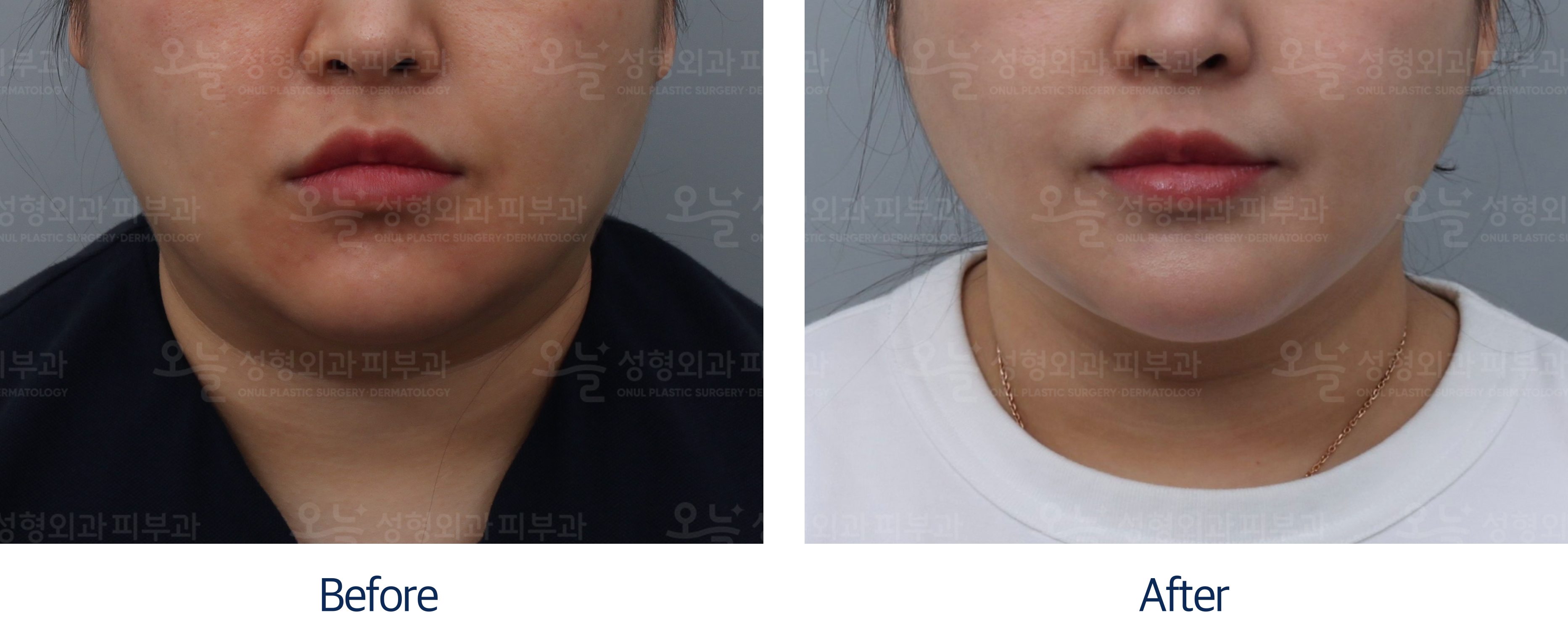 오늘성형외과 전후사진