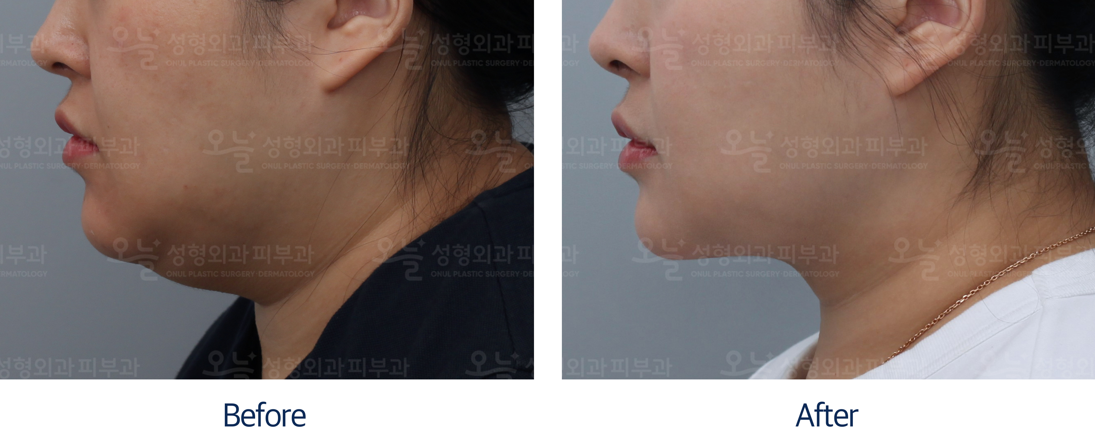 오늘성형외과 전후사진