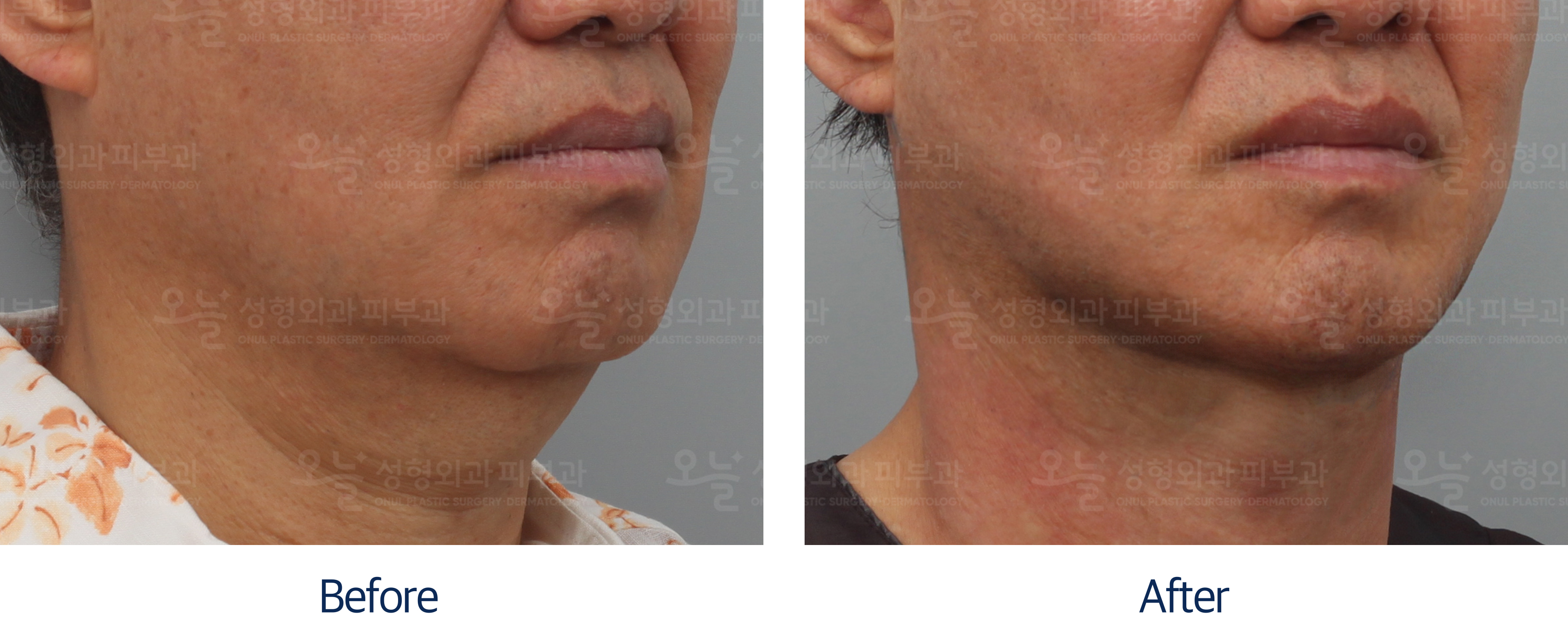 오늘성형외과 전후사진