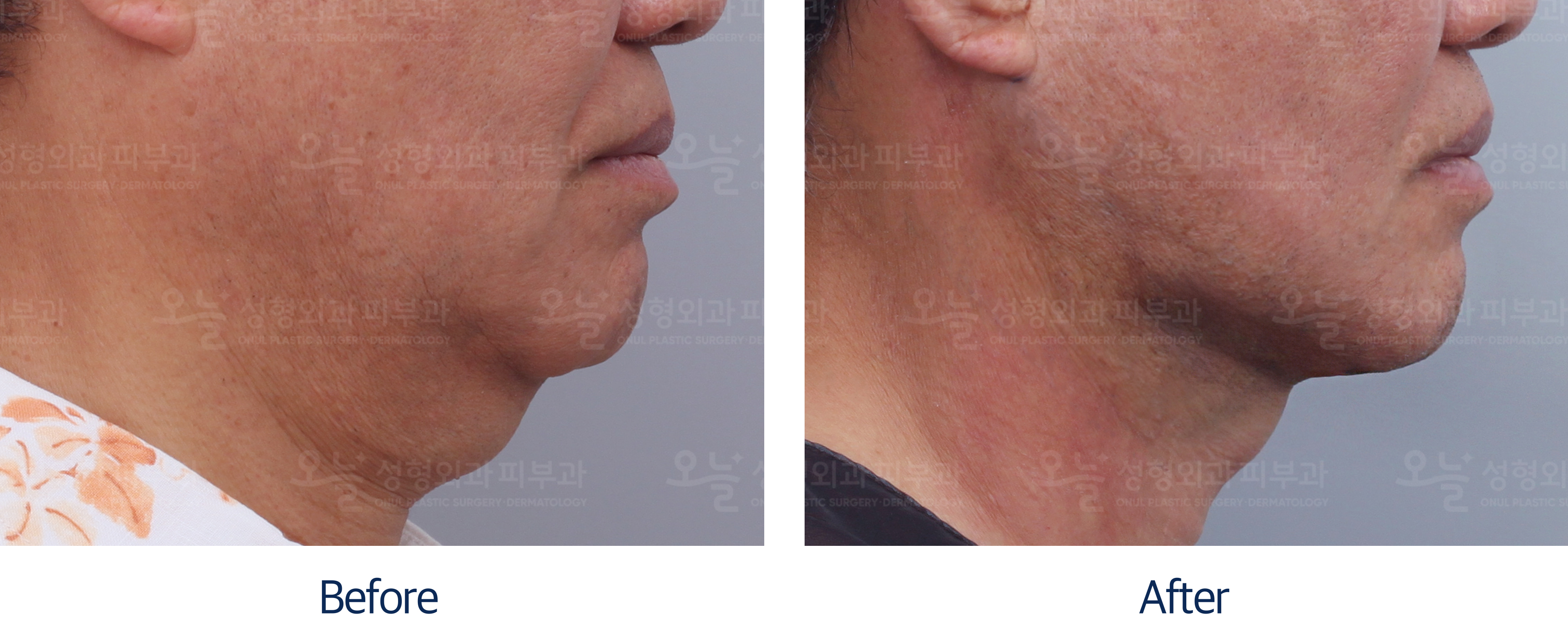 오늘성형외과 전후사진