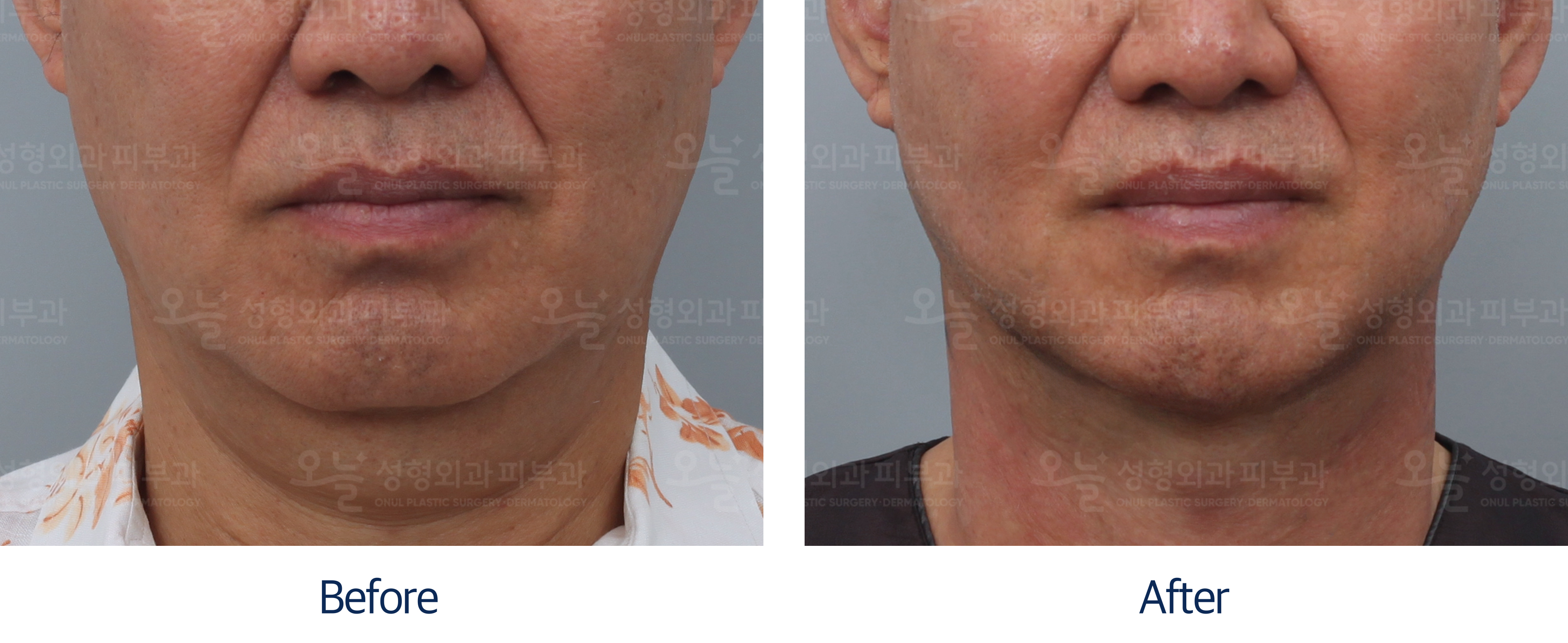 오늘성형외과 전후사진