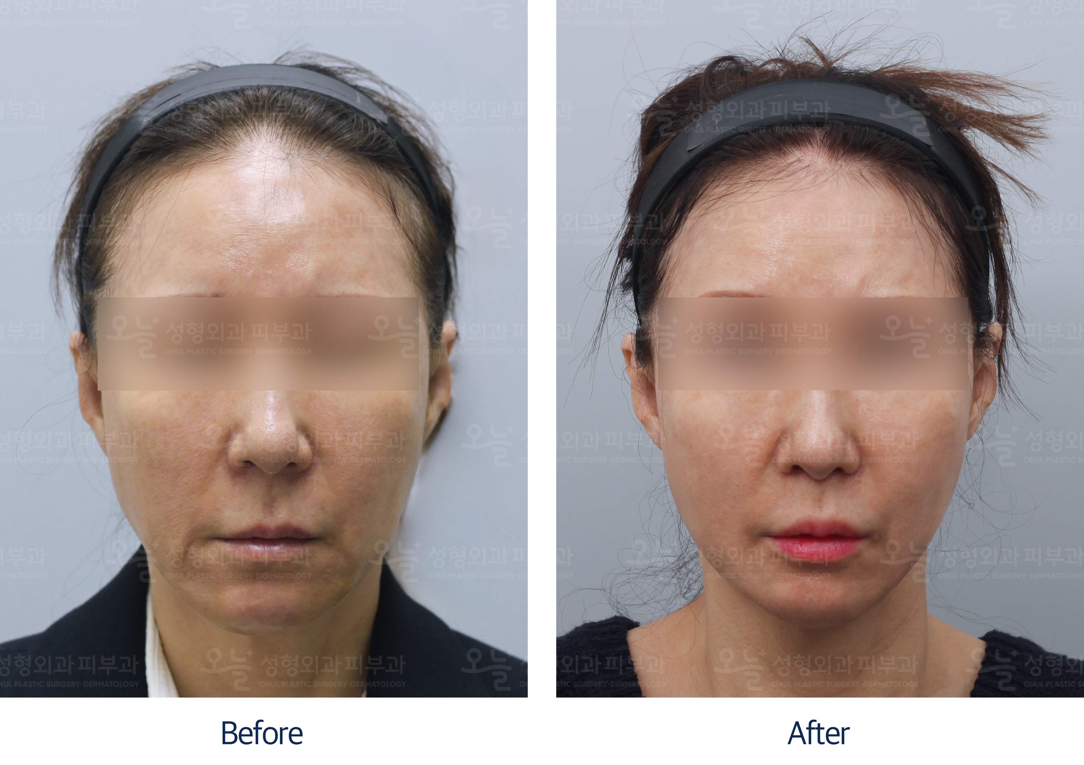 오늘성형외과 전후사진