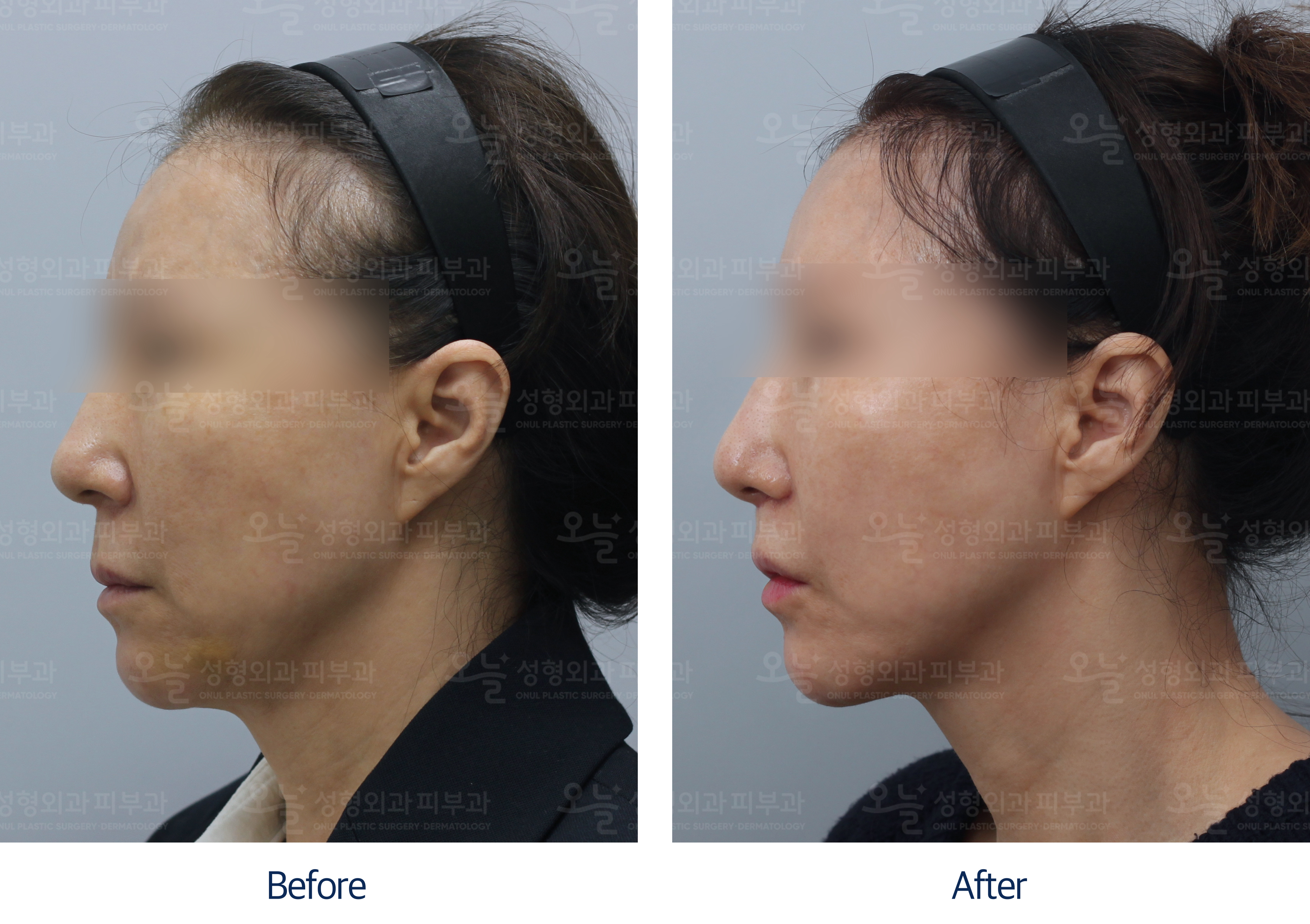 오늘성형외과 전후사진