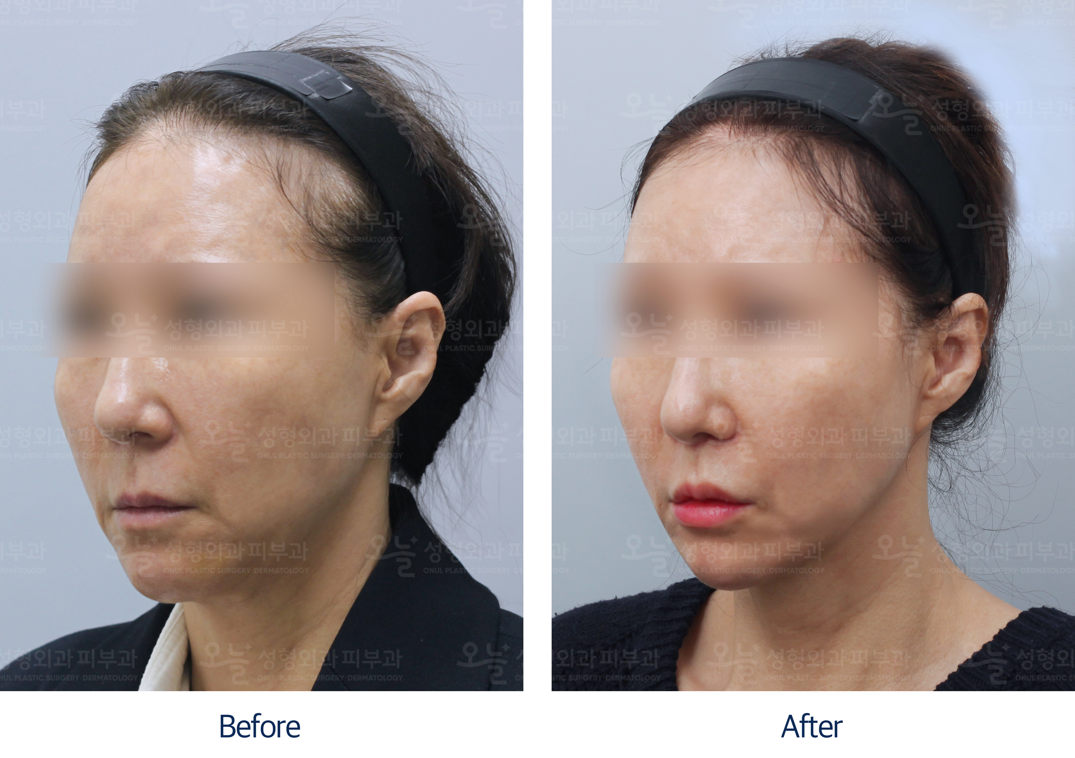 오늘성형외과 전후사진