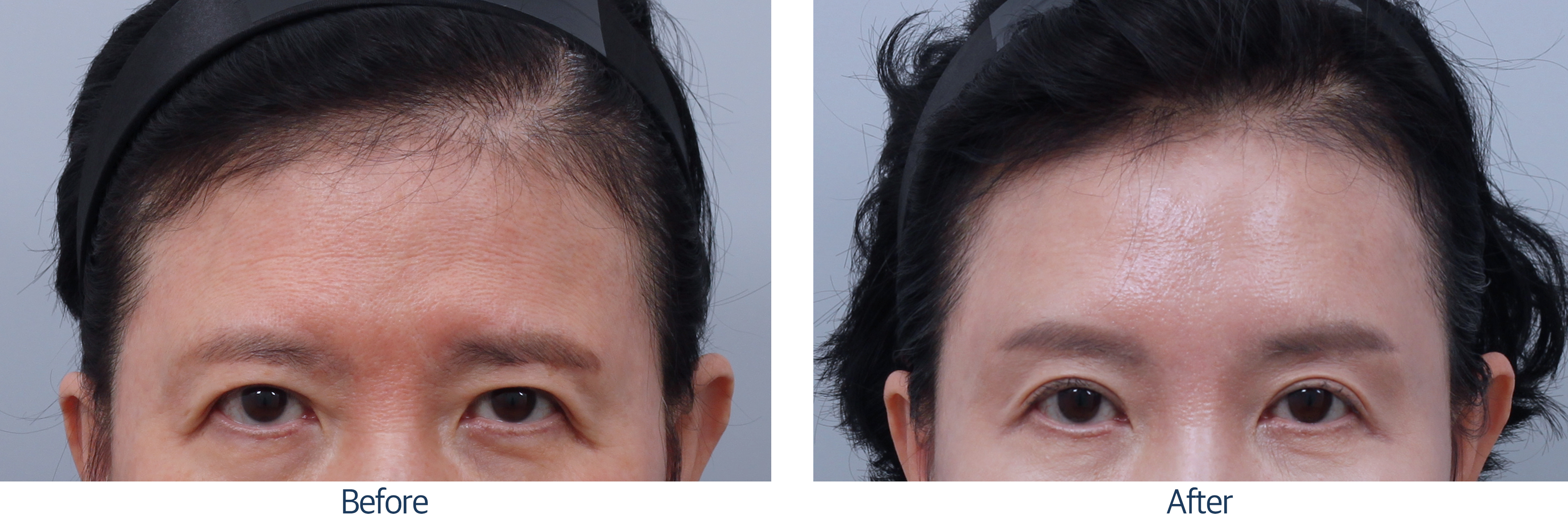 오늘성형외과 전후사진