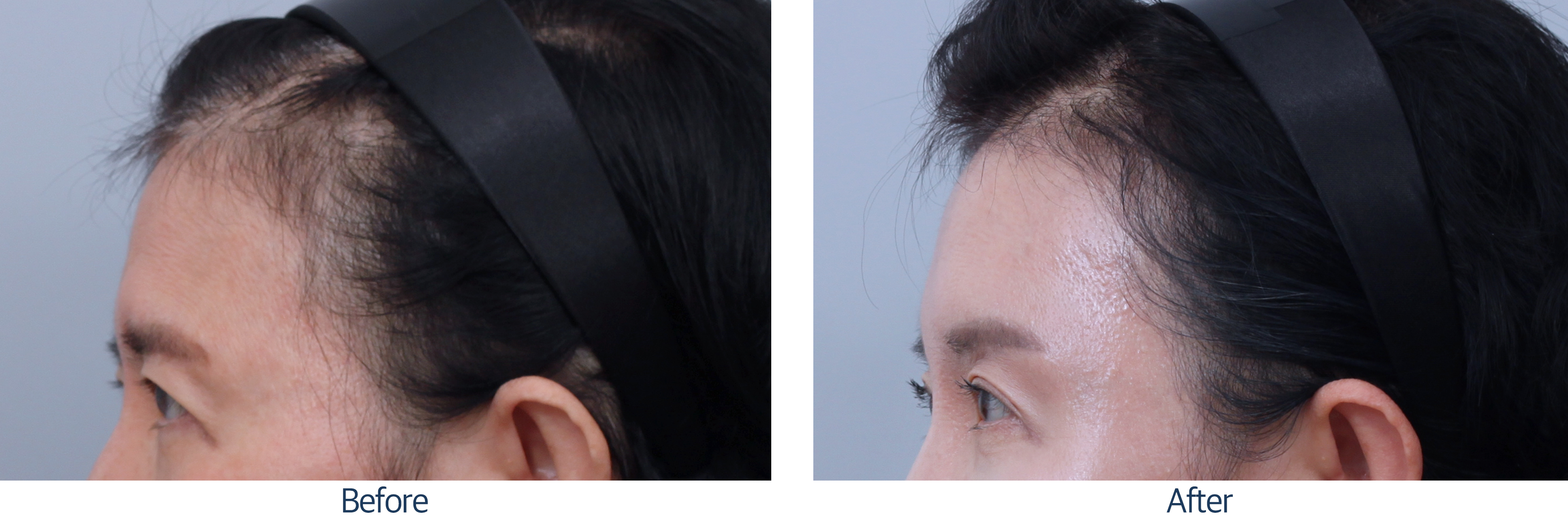 오늘성형외과 전후사진