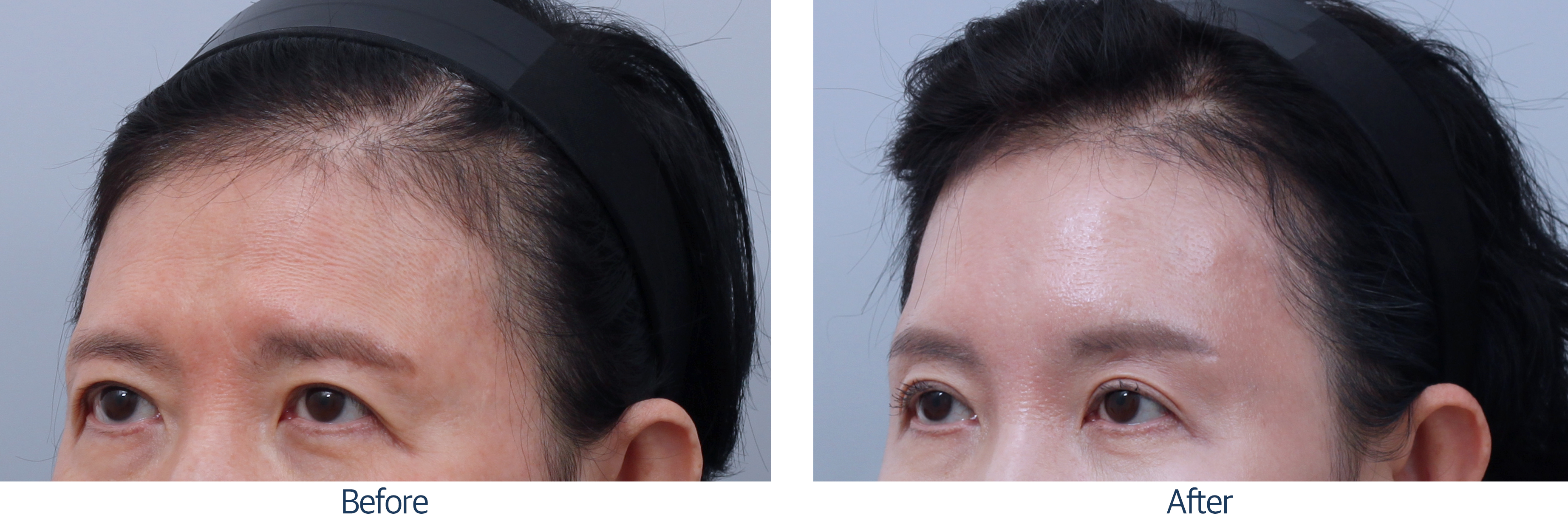 오늘성형외과 전후사진