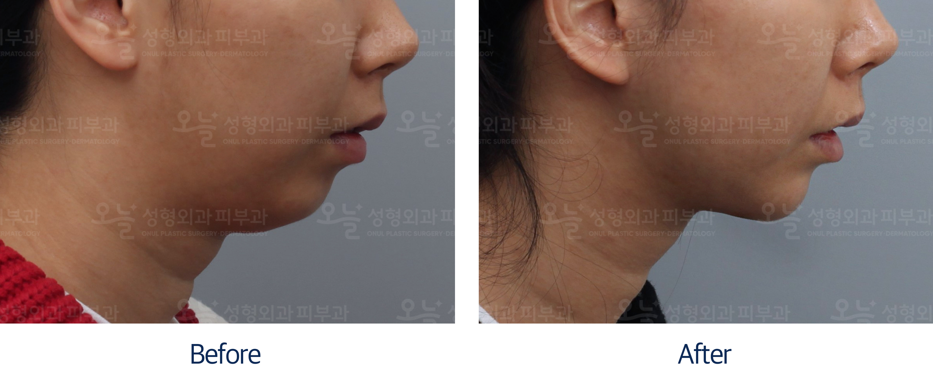 오늘성형외과 전후사진