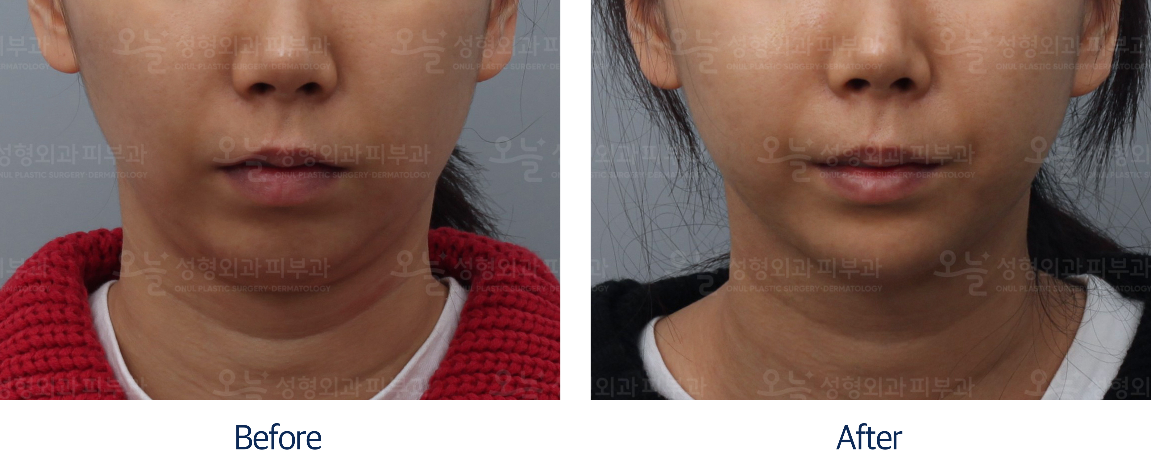 오늘성형외과 전후사진