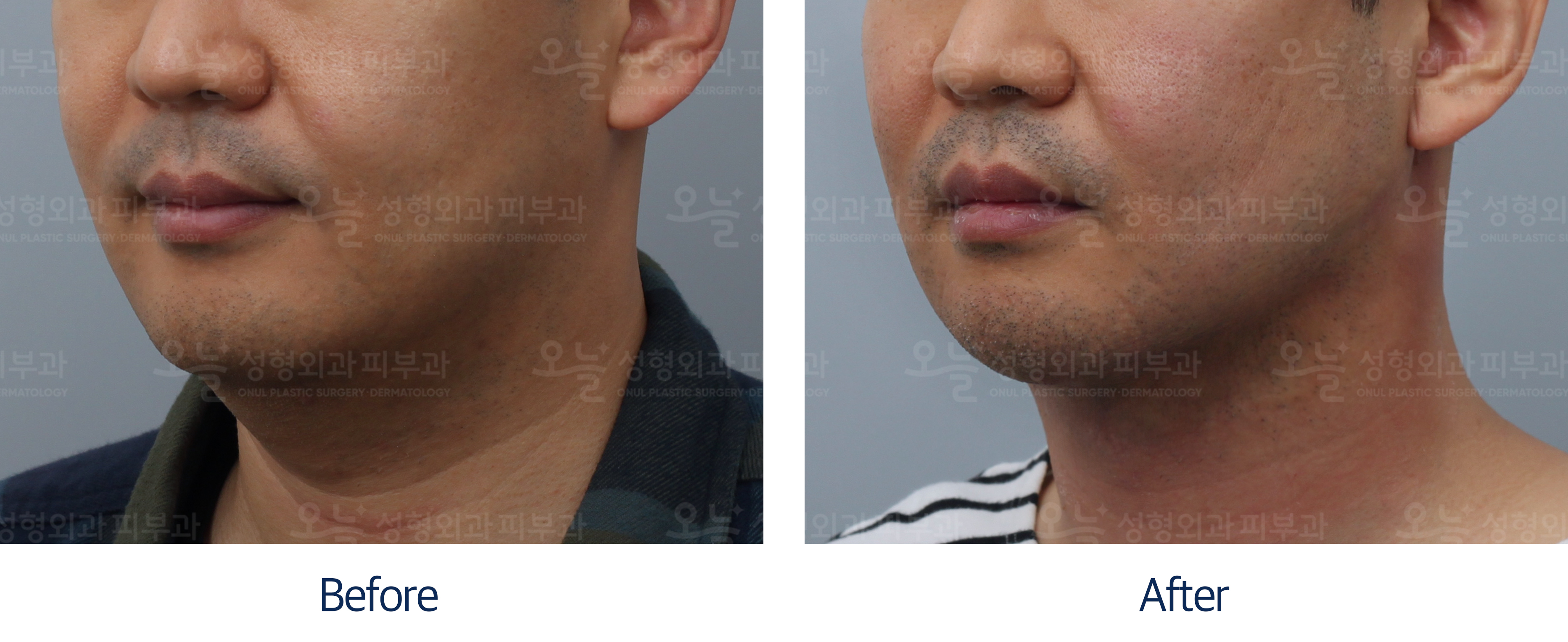 오늘성형외과 전후사진