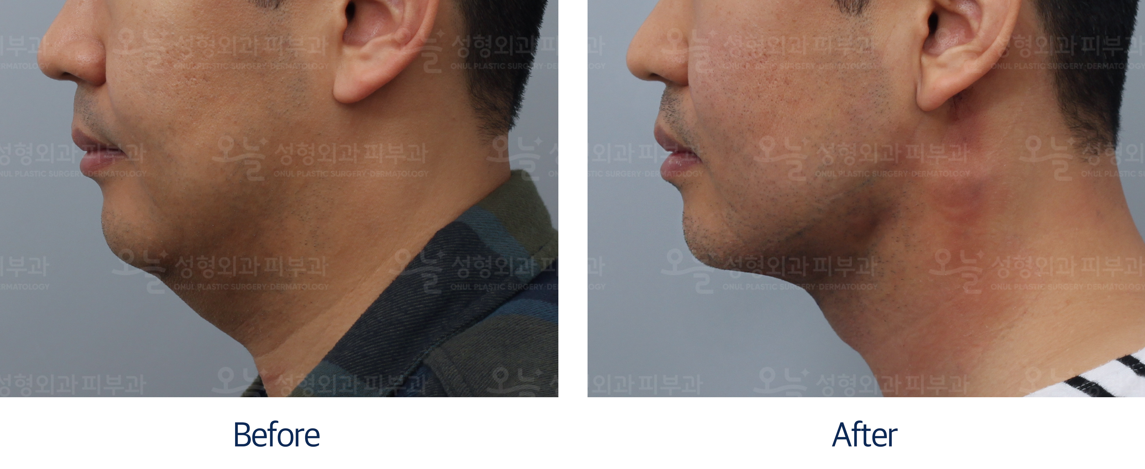 오늘성형외과 전후사진