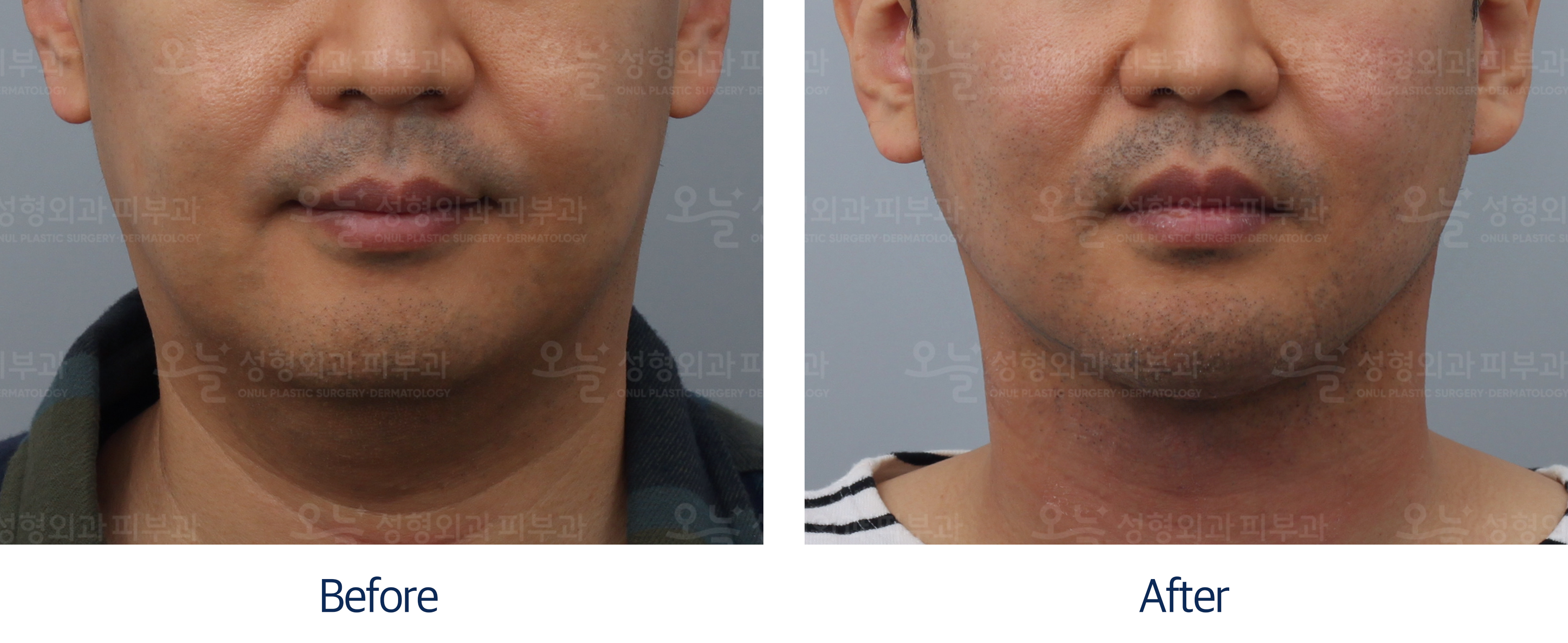 오늘성형외과 전후사진