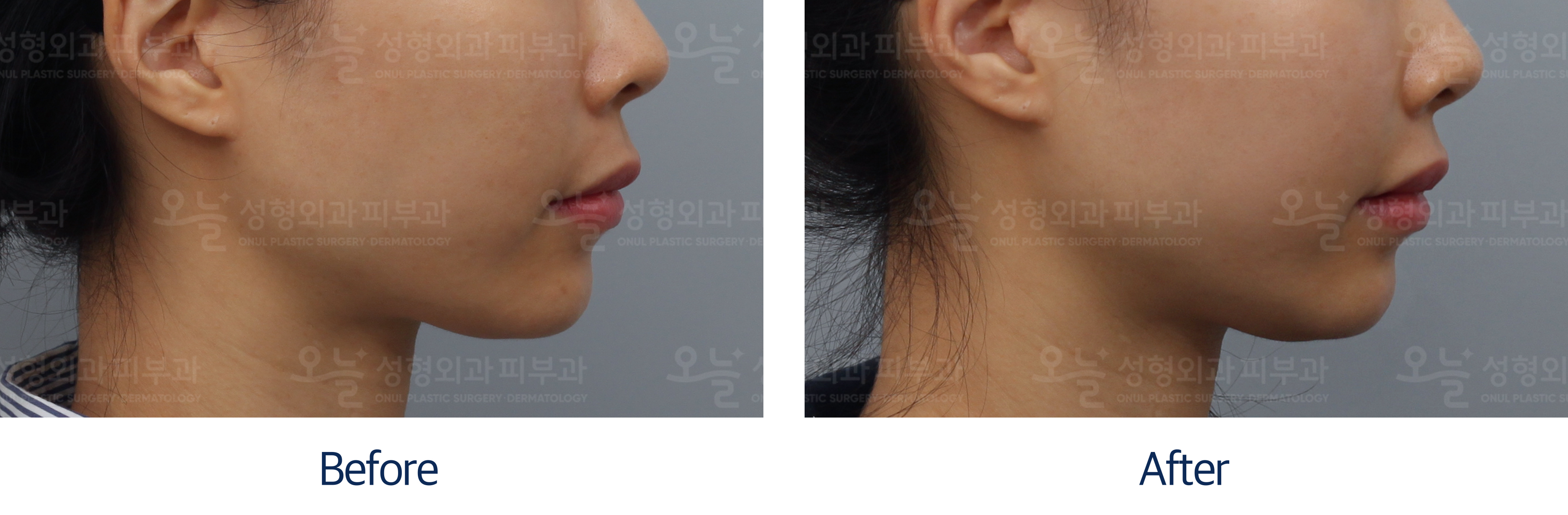 오늘성형외과 전후사진
