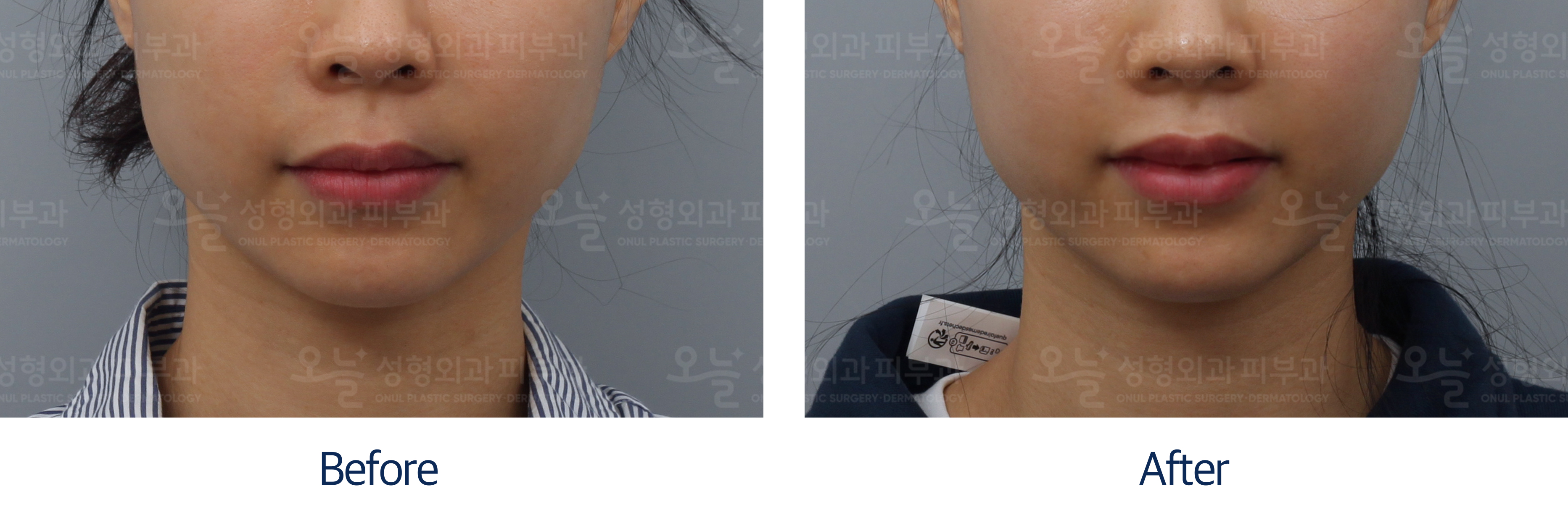오늘성형외과 전후사진