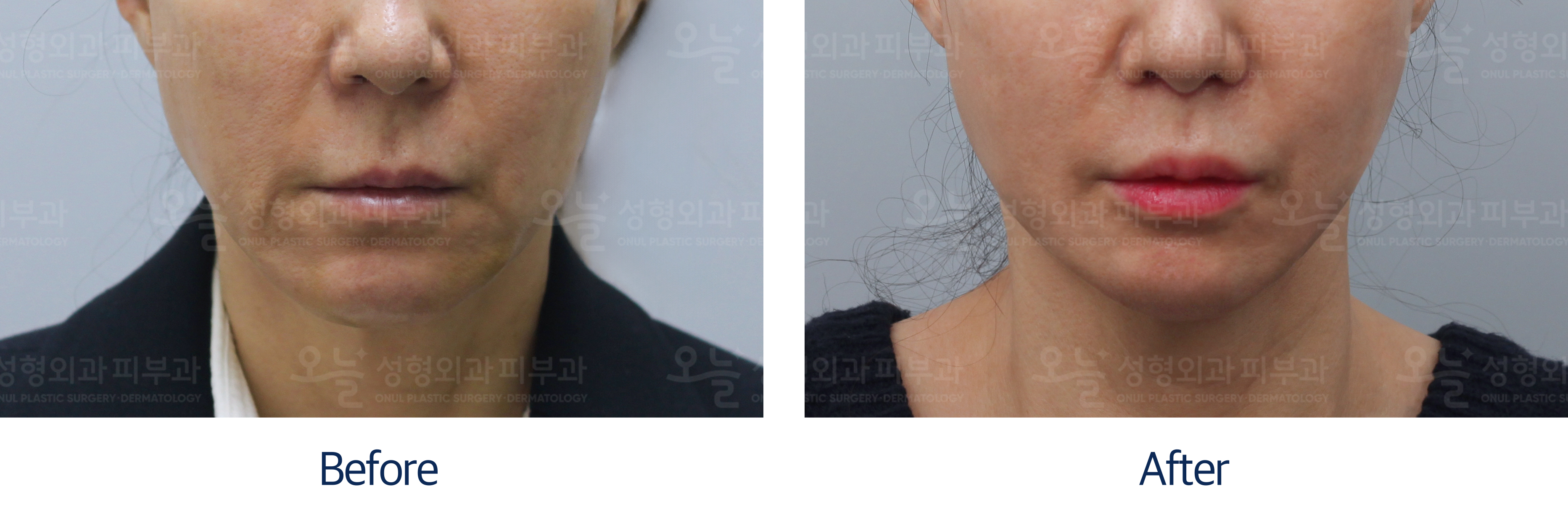 오늘성형외과 전후사진